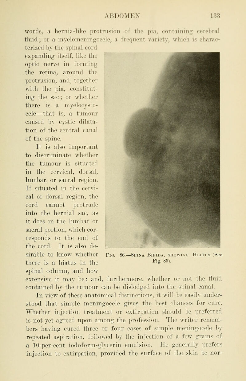 words, a hernia-like protrusion of the pia, containing cerebral fluid; or a myelomeningocele, a frequent variety, which is charac- terized by the spinal cord expanding itself, like the optic nerve in forming the retina, around the protrusion, and, together with the pia, constitut- ing the sac; or whether there is a myelocysto- cele—that is, a tumour caused by cystic dilata- tion of the central canal of the spine. It is also important to discriminate whether the tumour is situated in the cervical, dorsal, lumbar, or sacral region. If situated in the cervi- cal or dorsal region, the cord cannot protrude into the hernial sac, as it does in the lumbar or sacral portion, which cor- responds to the end of the cord. It is also de- sirable to know whether there is a hiatus in the spinal column, and how extensive it may be; and, furthermore, whether or not the fluid contained by the tumour can be dislodged into the spinal canal. In view of these anatomical distinctions, it will be easily under- stood that simple meningocele gives the best chances for cure. Whether injection treatment or extirpation should be preferred is not yet agreed upon among the profession. The writer remem- bers having cured three or four cases of simple meningocele by repeated aspiration, followed by the injection of a few grains of a 10-per-cent iodoform-glycerin emulsion. He generally prefers injection to extirpation, provided the surface of the skin be nor- FlG. .—Spina Bifida, showing Hiatus (See Pig. 85).