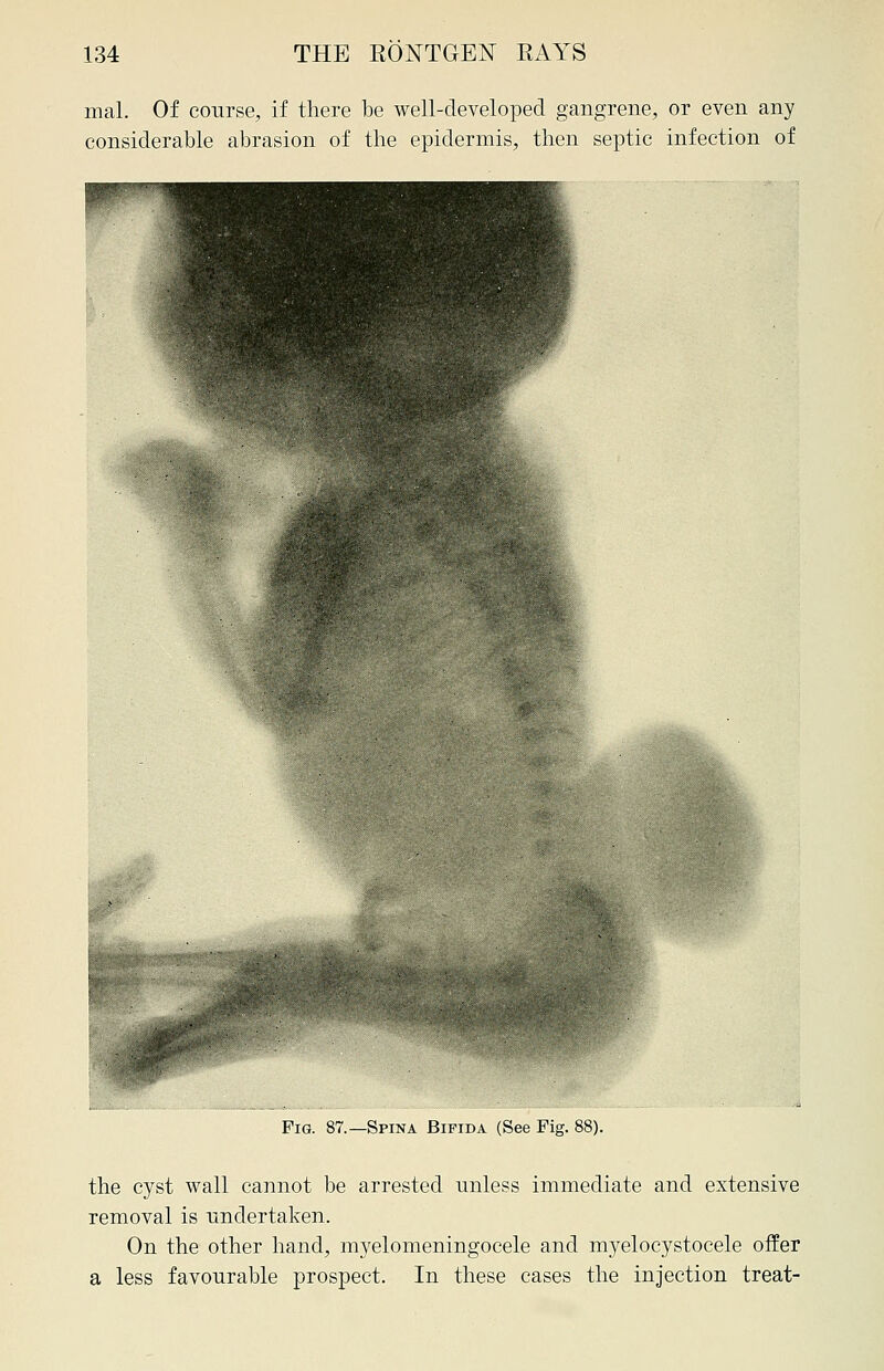 mal. Of course, if there be well-developed gangrene, or even any considerable abrasion of the epidermis, then septic infection of Fig. 87.—Spina Bifida (See Fig. 88). the cyst wall cannot be arrested unless immediate and extensive removal is undertaken. On the other hand, myelomeningocele and myelocystocele offer a less favourable prospect. In these cases the injection treat-
