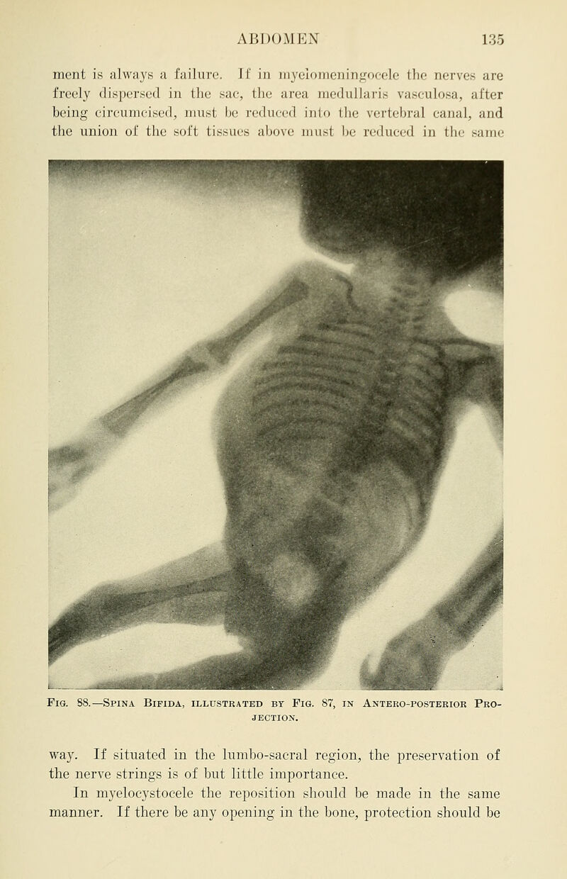 ment is always a failure. I J' in myelomeningocele the nerves are freely dispersed in the sac, the area medullaris vasculosa, after being circumcised, must be reduced into the vertebral canal, and the union of the soft tissues above must be reduced in the same -Spina Bifida, illustrated by Fig. 87, in Anteroposterior Pro- jection. way. If situated in the lumbo-sacral region, the preservation of the nerve strings is of but little importance. In myelocystocele the reposition should be made in the same manner. If there be any opening in the bone, protection should be