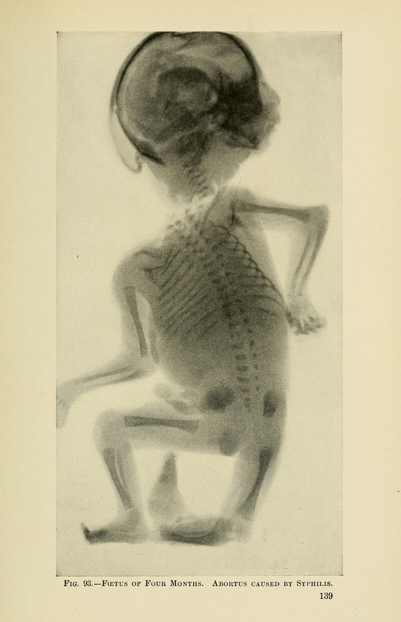Fig. 93.— Foetus of Four Months. Abortus caused by Syphilis.