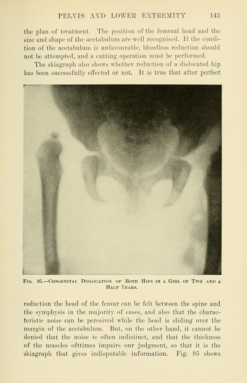 the plan of treatment. The position of the femoral head and the size and shape of the acetabulum are well recognised. If the condi- tion of the acetabulum is unfavourable, bloodless reduction should not be attempted, and a cutting operation must be performed. The skiagraph also shows whether reduction of a dislocated hip has been successfully effected or not. It is true that after perfect Pig. 95.—Congenital Dislocation of Both Hips in a Gikl of Two and a Half Years. reduction the head of the femur can be felt between the spine and the symphysis in the majority of cases, and also that the charac- teristic noise can be perceived while the head is sliding over the margin of the acetabulum. But, on the other hand, it cannot be denied that the noise is often indistinct, and that the thickness of the muscles ofttimes impairs our judgment, so that it is the skiagraph that gives indisputable information. Fig. 95 shows