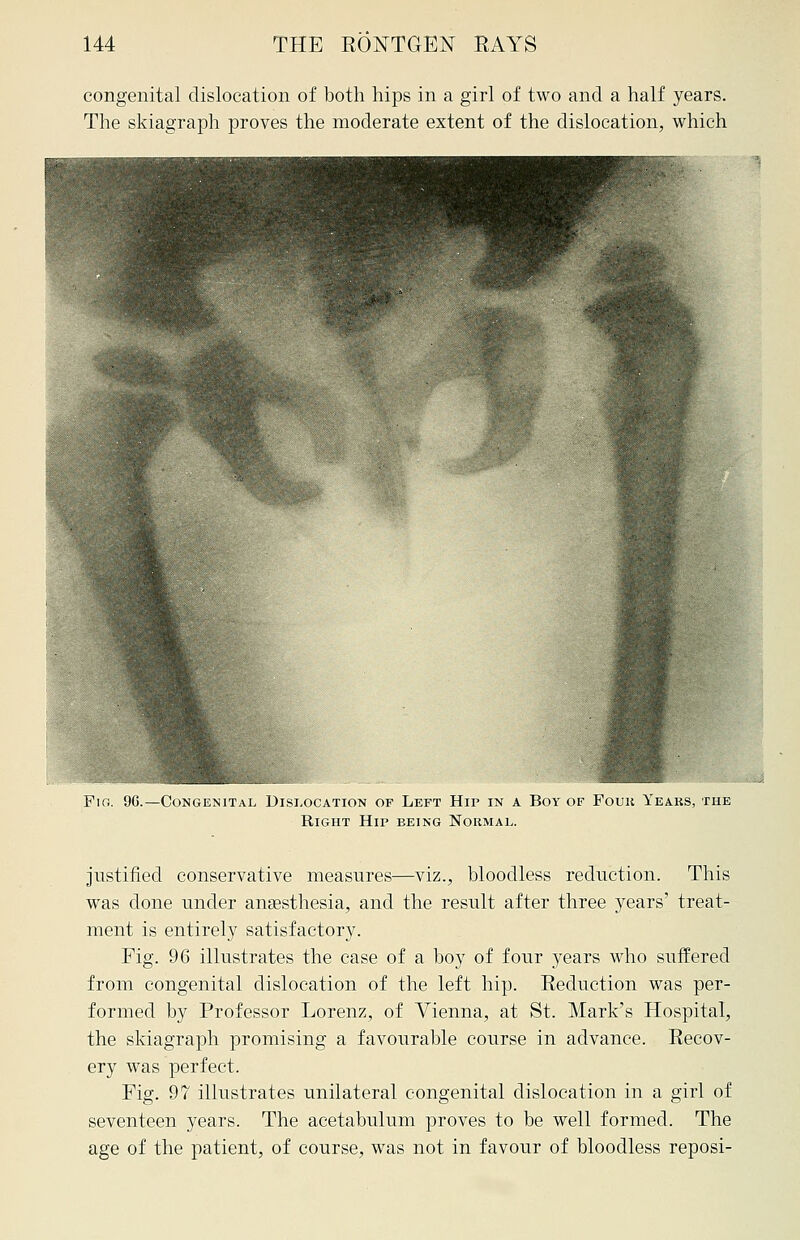 congenital dislocation of both hips in a girl of two and a half years. The skiagraph proves the moderate extent of the dislocation, which Fio. 96.—Congenital Dislocation of Left Hip in a Boy of Foun Years, the Right Hip being Normal. justified conservative measures—viz., bloodless reduction. This was done under anaesthesia, and the result after three years' treat- ment is entirely satisfactory. Fig. 96 illustrates the case of a boy of four years who suffered from congenital dislocation of the left hip. Reduction was per- formed by Professor Lorenz, of Vienna, at St. Mark's Hospital, the skiagraph promising a favourable course in advance. Recov- ery was perfect. Fig. 97 illustrates unilateral congenital dislocation in a girl of seventeen years. The acetabulum proves to be well formed. The age of the patient, of course, was not in favour of bloodless reposi-