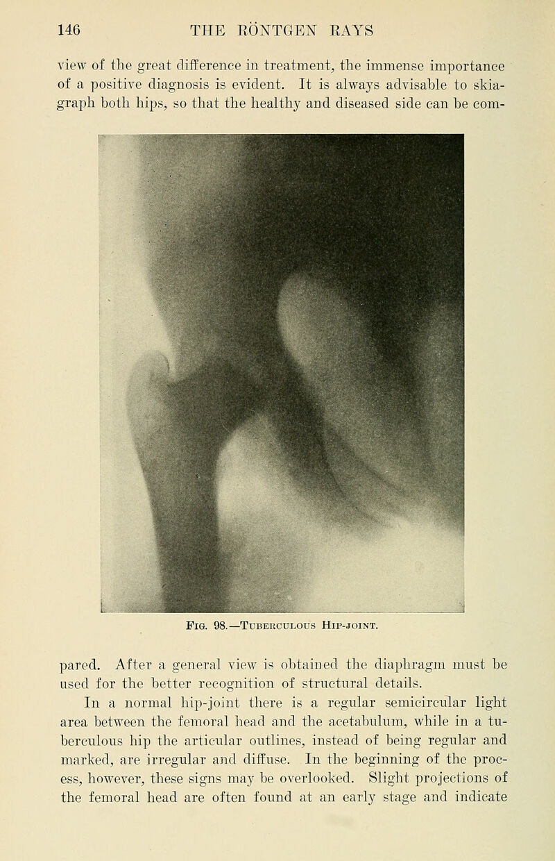 view of the great difference in treatment, the immense importance of a positive diagnosis is evident. It is always advisable to skia- graph both hips, so that the healthy and diseased side can be com- TUBERCULOUS HlP-JOINT. pared. After a general view is obtained the diaphragm must be used for the better recognition of structural details. In a normal hip-joint there is a regular semicircular light area between the femoral head and the acetabulum, while in a tu- berculous hip the articular outlines, instead of being regular and marked, are irregular and diffuse. In the beginning of the proc- ess, however, these signs may be overlooked. Slight projections of the femoral head are often found at an early stage and indicate