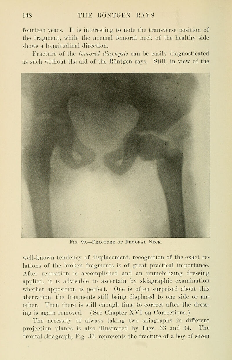 fourteen years. It is interesting to note the transverse position of the fragment, while the normal femoral neck of the healthy side shows a longitudinal direction. Fracture of the femoral diaplujsis can be easily diagnosticated as such without the aid of the Rontgen rays. Still, in view of the Pig. 99.—Fracture of Femoral Neck. well-known tendency of displacement, recognition of the exact re- lations of the broken fragments is of great practical importance. After reposition is accomplished and an immobilizing dressing applied, it is advisable to ascertain by skiagraphic examination whether apposition is perfect. One is often surprised about this aberration, the fragments still being displaced to one side or an- other. Then there is still enough time to correct after the dress- ing is again removed. (See Chapter XYI on Corrections.) The necessity of always taking two skiagraphs in different projection planes is also illustrated hy Figs. 33 and 31. The frontal skiagraph, Fig. 33, represents the fracture of a boy of seven