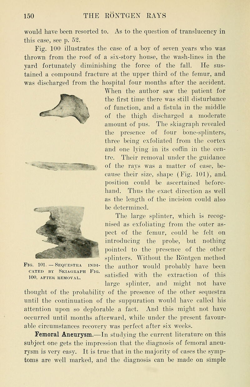 **' '^\ ' would have been resorted to. As to the question of translueency in this case, see p. 52. Fig. 100 illustrates the case of a boy of seven years who was thrown from the roof of a six-story house, the wash-lines in the yard fortunately diminishing the force of the fall. He sus- tained a compound fracture at the upper third of the femur, and was discharged from the hospital four months after the accident. When the author saw the patient for the first time there was still disturbance of function, and a fistula in the middle of the thigh discharged a moderate amount of pus. The skiagraph revealed the presence of four bone-splinters, three being exfoliated from the cortex and one lying in its coffin in the cen- tre. Their removal under the guidance of the rays was a matter of ease, be- cause their size, shape (Fig. 101), and position could be ascertained before- hand. Thus the exact direction as well as the length of the incision could also be determined. The large splinter, which is recog- nised as exfoliating from the outer as- pect of the femur, could be felt on introducing the probe, but nothing pointed to the presence of the other splinters. Without the Rontgen method the author would probably have been satisfied with the extraction of this large splinter, and might not have thought of the probability of the presence of the other sequestra until the continuation of the suppuration would have called his attention upon so deplorable a fact. And this might not have occurred until months afterward, while under the present favour- able circumstances recovery was perfect after six weeks. Femoral Aneurysm.—In studying the current literature on this subject one gets the impression that the diagnosis of femoral aneu- rysm is very easy. It is true that in the majority of cases the symp- toms are well marked, and the diagnosis can be made on simple Fig. 101. — Sequestra indi- cated by Skiagraph Fig. 100, after removal.