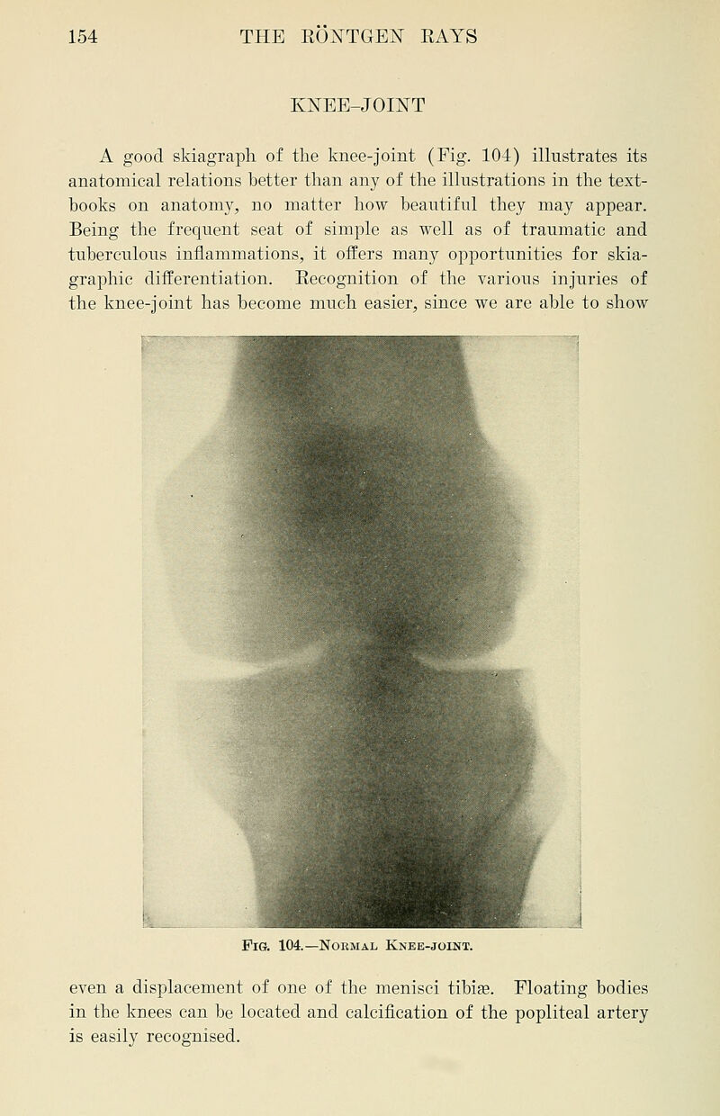 KNEE-JOINT A good skiagraph of the knee-joint (Fig. 104) illustrates its anatomical relations better than any of the illustrations in the text- books on anatomy, no matter how beautiful they may appear. Being the frequent seat of simple as well as of traumatic and tuberculous inflammations, it offers many opportunities for skia- graphy differentiation. Eecognition of the various injuries of the knee-joint has become much easier, since we are able to show Fig. 104.—Normal Knee-joint. even a displacement of one of the menisci tibiae. Floating bodies in the knees can be located and calcification of the popliteal artery is easily recognised.