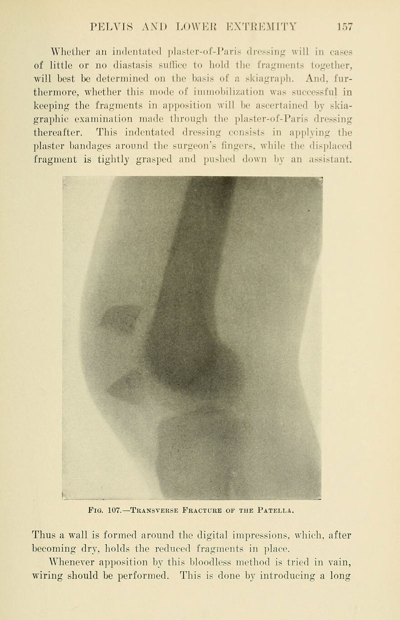 Whether an indentated plaster-of-Paris dressing will in cases of little or no diastasis suffice to bold the fragments together, will best be determined on the basis of a skiagraph. And, fur- thermore, whether this mode of immobilization was successful in keeping the fragments in apposition will be ascertained by skia- graphy examination mode through the plaster-of-Paris dressing thereafter. This indentated dressing consists in applying the plaster bandages around the surgeon's fingers, while the displaced fragment is tightly grasped and pushed down by an assistant. Pig. 107.—Transverse Fracture of the Patella. Thus a wall is formed around the digital impressions, which, after becoming dry, holds the reduced fragments in place. Whenever apposition by this bloodless method is tried in vain, wiring should be performed. This is done by introducing a long