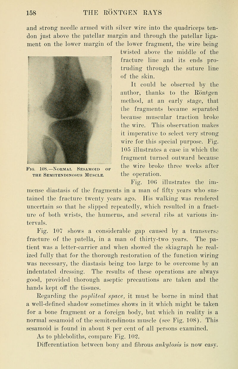 Fig. 108.—Normal Sesamoid of the Semitendinosus Muscle. and strong needle armed with silver wire into the quadriceps ten- don just above the patellar margin and through the patellar liga- ment on the lower margin of the lower fragment;, the wire being twisted above the middle of the fracture line and its ends pro- truding through the suture line of the skin. It could be observed by the author, thanks to the Bontgen method, at an early stage, that the fragments became separated because muscular traction broke the wire. This observation makes it imperative to select very strong wire for this special purpose. Fig. 105 illustrates a case in which the fragment turned outward because the wire broke three weeks after the operation. Fig. 106 illustrates the im- mense diastasis of the fragments in a man of fifty years who sus- tained the fracture twenty years ago. His walking was rendered uncertain so that he slipped repeatedly, which resulted in a fract- ure of both wrists, the humerus, and several ribs at various in- tervals. Fig. 107 shows a considerable gap caused by a transversa fracture of the patella, in a man of thirty-two years. The pa- tient was a letter-carrier and when showed the skiagraph he real- ized fully that for the thorough restoration of the function wiring was necessary, the diastasis being too large to be overcome by an indentated dressing. The results of these operations are always good, provided thorough aseptic precautions are taken and the hands kept off the tissues. Regarding the popliteal space, it must be borne in mind that a well-defined shadow sometimes shows in it which might be taken for a bone fragment or a foreign body, but which in reality is a normal sesamoid of the semitendinous muscle (see Fig. 108). This sesamoid is found in about 8 per cent of all persons examined. As to phleboliths, compare Fig. 102. Differentiation between bony and fibrous ankylosis is now easy.