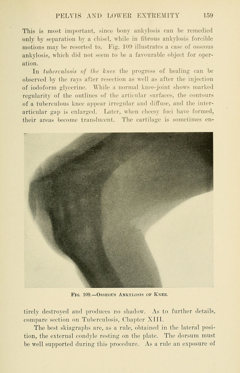 This is most important, since bony ankylosis can be remedied only by separation by a chisel, while in fibrous ankylosis forcible motions may be resorted to. Fig. 109 illustrates a case of osseous ankylosis, which did not seem to be a favourable object for oper- ation. In tuberculosis of the lenee the progress of healing can be observed by the rays after resection as well as after the injection of iodoform glycerine. While a norma] knee-joint .-bows marked regularity of the outlines of the articular surfaces, the contours of a tuberculous knee appear irregular and diffuse, and the inter- articular gap is enlarged. Later, when cheesy Foci have formed, their areas become translucent. The cartilage is sometimes en- Fig. 109.—Osseous Ankylosis of Knee. tirely destroyed and produces no shadow. As to further details, compare section on Tuberculosis, Chapter XIII. The best skiagraphs are, as a rule, obtained in the lateral posi- tion, the external condyle resting on the plate. The dorsum must be well supported during this procedure. As a rule an exposure of