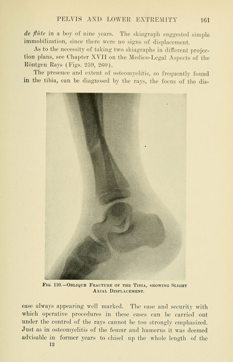 de flute in a boy of nine years. The skiagraph suggested simple immobilization, since there were no signs of displacement, As to the necessity of taking two skiagraphs in different projec- tion plans, see Chapter XVII on the Medico-Legal Aspects of the Rontgen Rays (Figs. 259, 260). The presence and extent of osteomyelitis, so frequently found in the tibia, can be diagnosed by the rays, the focus of the dis- Fig. 110.—Oblique Fracture of the Tibia, showing Slight Axial Displacement. ease always appearing well marked. The ease and security with which operative procedures in these cases can be carried out under the control of the rays cannot be too strongly emphasized. Just as in osteomyelitis of the femur and humerus it was deemed advisable in former years to chisel up the whole length of the 12