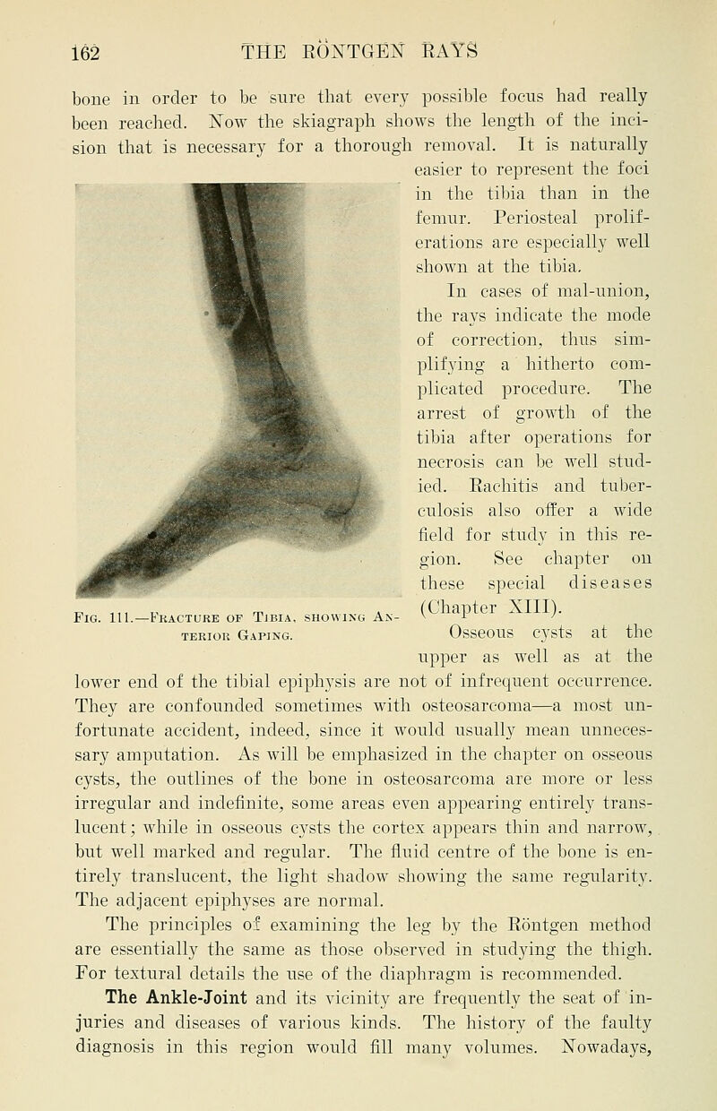 bone in order to be sure that every possible focns had really been reached. Now the skiagraph shows the length of the inci- sion that is necessary for a thorough removal. It is naturally easier to represent the foci in the tibia than in the femur. Periosteal prolif- erations are especially well shown at the tibia. In cases of mal-union, the rays indicate the mode of correction, thus sim- plifying a hitherto com- plicated procedure. The arrest of growth of the tibia after operations for necrosis can be well stud- ied. Rachitis and tuber- culosis also offer a wide field for study in this re- gion. See chapter on these special diseases (Chapter XIII). Osseous cysts at the upper as well as at the lower end of the tibial epiphysis are not of infrequent occurrence. They are confounded sometimes with osteosarcoma—a most un- fortunate accident, indeed, since it would usually mean unneces- sary amputation. As will be emphasized in the chapter on osseous cysts, the outlines of the bone in osteosarcoma are more or less irregular and indefinite, some areas even appearing entirely trans- lucent; while in osseous cysts the cortex appears thin and narrow, but well marked and regular. The fluid centre of the bone is en- tirely translucent, the light shadow showing the same regularity. The adjacent epiphyses are normal. The principles of examining the leg by the Rontgen method are essentially the same as those observed in studying the thigh. For textural details the use of the diaphragm is recommended. The Ankle-Joint and its vicinity are frequently the seat of in- juries and diseases of various kinds. The history of the faulty diagnosis in this region would fill many volumes. Nowadays, Pig. 111.—Fracture of Tjbia, showing An- terior Gaping.