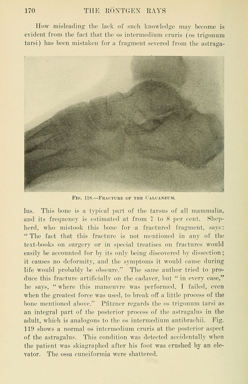 How misleading the lack of such knowledge may become is evident from the fact that the os intermedium cruris (os trigonum tarsi) has been mistaken for a fragment severed from the astraga- Pio. 118.—Fracture of the Calcaneum. lus. This bone is a typical part of the tarsus of all mammalia, and its frequency is estimated at from 7 to 8 per cent. Shep- herd, who mistook this bone for a fractured fragment, says:  The fact that this fracture is not mentioned in any of the text-books on surgery or in special treatises on fractures would easily be accounted for by its only being discovered by dissection; it causes no deformity, and the s3rmptoms it would cause during life would probably be obscure. The same author tried to pro- duce this fracture artificially on the cadaver, but  in every case, he says,  where this manoeuvre was performed, I failed, even when the greatest force was used, to break off a little process of the bone mentioned above. Pfitzner regards the os trigonum tarsi as an integral part of the posterior process of the astragalus in the adult, which is analogous to the os intermedium antibrachii. Fig. 119 shows a normal os intermedium cruris at the posterior aspect of the astragalus. This condition was detected accidentally when the patient was skiagraphed after his foot was crushed by an ele- vator. The ossa cuneiformia were shattered.