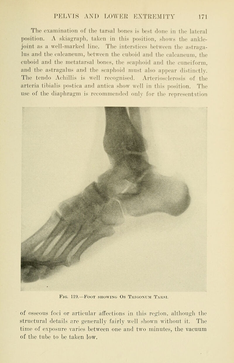 The examination of the tarsal bones is besi done in the Lateral position. A skiagraph, taken in this position, shows the ankle- joint as a well-marked Line. The interstices between the astraga- lus and the calcaneum, between the cuboid and the calcaneum, the cuboid and the metatarsal bones, the scaphoid and the cuneiform, and the astragalus and the scaphoid must also appear distinct!v. The tendo Achillis is well recognised. Arteriosclerosis of the arteria tibialis postica and antica show well in tins position. The use of the diaphragm is recommended only for the representation Fig. 119.—Foot showing Os Thigonum Taksi. of osseous foci or articular affections in this region, although the structural details are generally fairly well shown without it. The time of exposure varies between one and two minutes, the vacuum of the tube to be taken low.