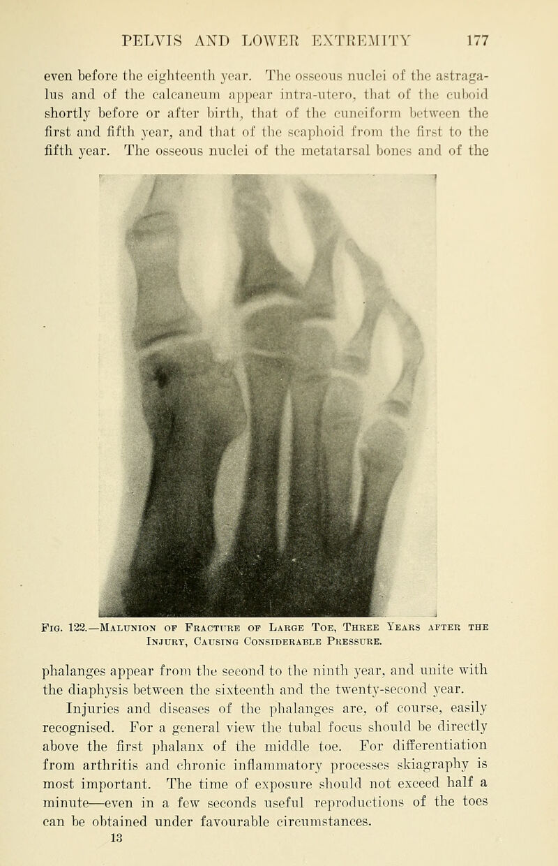 even before the eighteenth year. The osseous nuclei of the astraga- lus and of the calcaneum appear intra-utero, that of the cuboid shortly before or after birth, that of the cuneiform between the first and fifth year, and that of the scaphoid from the first to the fifth year. The osseous nuclei of the metatarsal bones and of the Pig. 122.—Malunion of Fracture of Large Toe, Three Years after the Injury, Causing Considerable Pressure. phalanges appear from the second to the ninth year, and unite with the diaphysis between the sixteenth and the twenty-second year. Injuries and diseases of the phalanges are, of course, easily recognised. For a general view the tubal focus should be directly above the first phalanx of the middle toe. For differentiation from arthritis and chronic inflammatory processes skiagraphy is most important. The time of exposure should not exceed half a minute—even in a few seconds useful reproductions of the toes can be obtained under favourable circumstances.