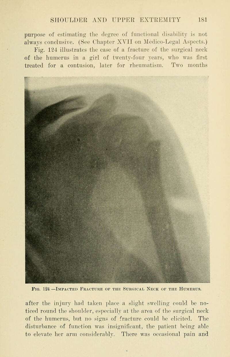 purpose of estimating the degree of functional disability is not always conclusive. (See Chapter XVII on Medico-Legal Aspects.) Fig. 124 illustrates the case of a fracture of the surgical neck of the humerus in a girl of twenty-four years, who was first treated for a contusion, later for rheumatism. Two months Fig. 124 —Impacted Fracture of the Surgical Neck of the Humerus. after the injury had taken place a slight swelling could be no- ticed round the shoulder, especially at the area of the surgical neck of the humerus, but no signs of fracture could be elicited. The disturbance of function was insignificant, the patient being able to elevate her arm considerably. There was occasional pain and