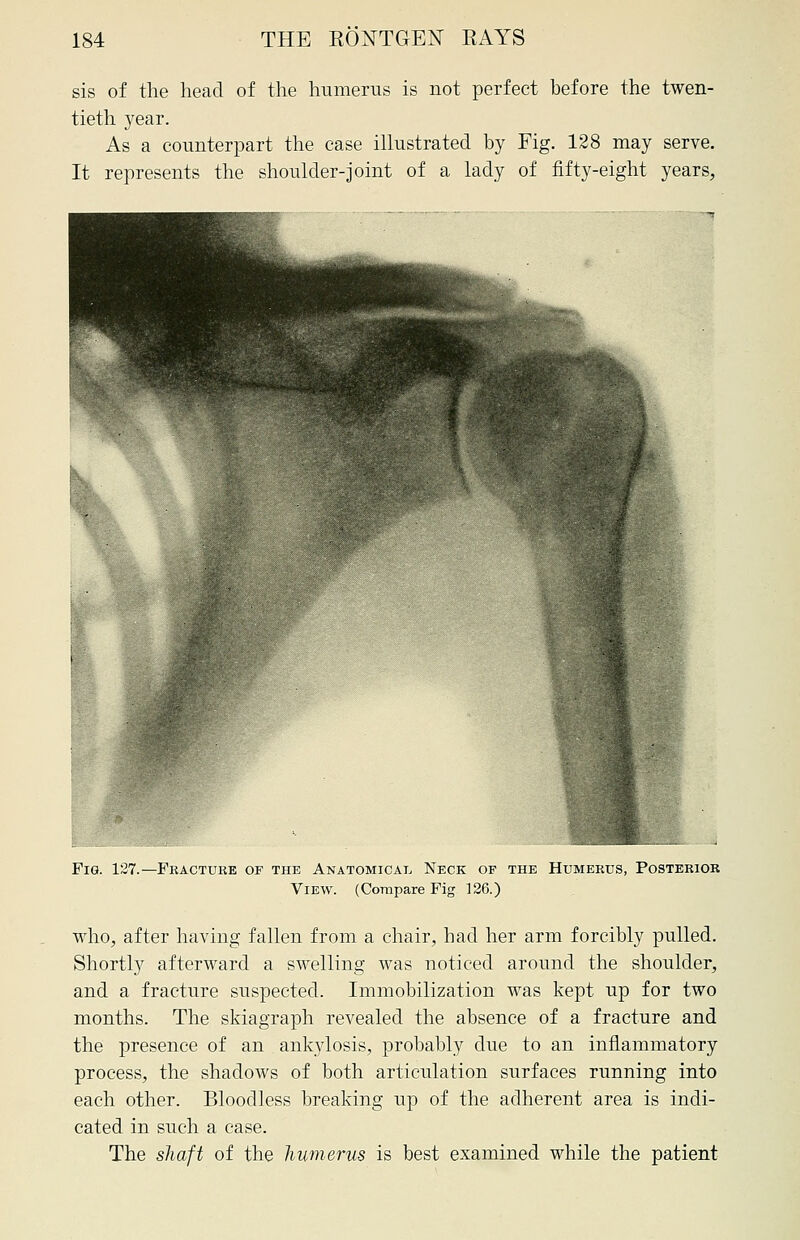 sis of the head of the humerus is not perfect before the twen- tieth year. As a counterpart the case illustrated by Fig. 128 may serve. It represents the shoulder-joint of a lady of fifty-eight years, Fig. 127.—Fracture of the Anatomical Neck of the Humerus, Posterior View. (Compare Fig 126.) who, after having fallen from a chair, had her arm forcibly pulled. Shortly afterward a swelling was noticed around the shoulder, and a fracture suspected. Immobilization was kept up for two months. The skiagraph revealed the absence of a fracture and the presence of an ankylosis, probably due to an inflammatory process, the shadows of both articulation surfaces running into each other. Bloodless breaking up of the adherent area is indi- cated in such a case. The shaft of the humerus is best examined while the patient