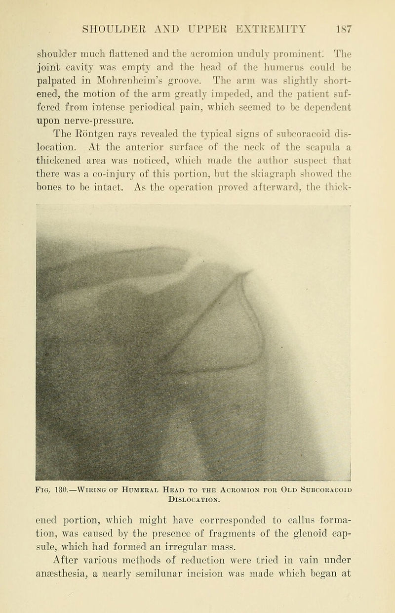 shoulder much flattened and the acromion unduly prominent! The joint cavity was empty and the head of the humerus could be palpated in MohreTiheim's groove. The arm was slightly short- ened, the motion of the arm greatly impelled, and the patient suf- fered from intense periodical pain, which seemed to be dependent upon nerve-pressure. The Kontgen rays revealed the typical signs of subcoracoid dis- location. At the anterior surface of the neck of the scapula a thickened area was noticed, which made the author suspect that there was a co-injury of this portion, but the skiagraph showed the bones to be intact. As the operation proved afterward, the thick- Fiq. 130.—Wiring of Humeral Head to the Acromion for Old Subcoracoid Dislocation. ened portion, which might have corrresponded to callus forma- tion, was caused by the presence of fragments of the glenoid cap- sule, which had formed an irregular mass. After various methods of reduction were tried in vain under anassthesia, a nearly semilunar incision was made which began at