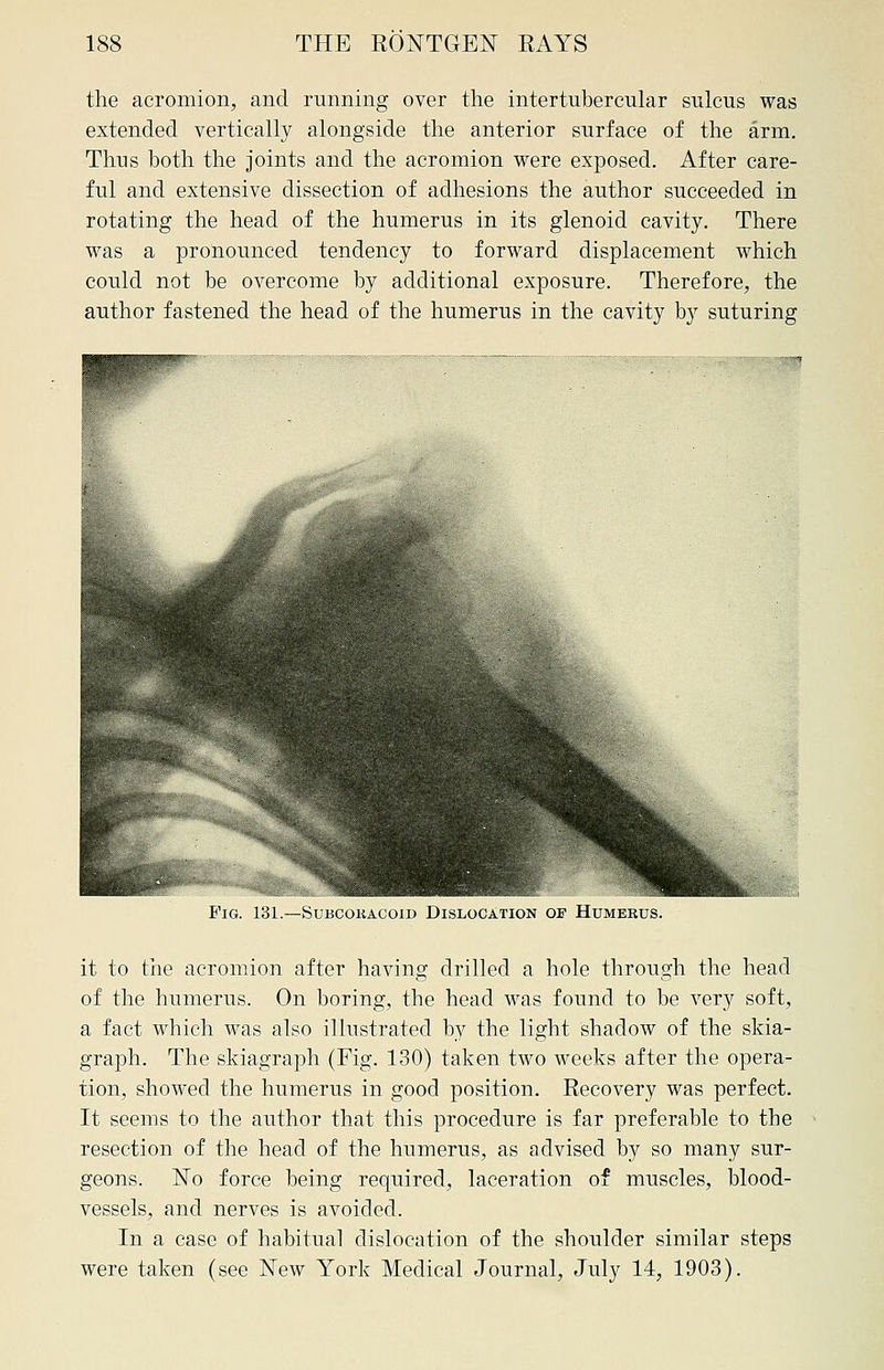 the acromion, and running over the intertubercular sulcus was extended vertically alongside the anterior surface of the arm. Thus both the joints and the acromion were exposed. After care- ful and extensive dissection of adhesions the author succeeded in rotating the head of the humerus in its glenoid cavity. There was a pronounced tendency to forward displacement which could not be overcome by additional exposure. Therefore, the author fastened the head of the humerus in the cavity by suturing Fig. 131.—Subcokacoid Dislocation of Humerus. it to the acromion after having drilled a hole through the head of the humerus. On boring, the head was found to be very soft, a fact which was also illustrated by the light shadow of the skia- graph. The skiagraph (Fig. 130) taken two weeks after the opera- tion, showed the humerus in good position. Recovery was perfect. It seems to the author that this procedure is far preferable to the resection of the head of the humerus, as advised by so many sur- geons. No force being required, laceration of muscles, blood- vessels, and nerves is avoided. In a case of habitual dislocation of the shoulder similar steps were taken (see New York Medical Journal, July 14, 1903).