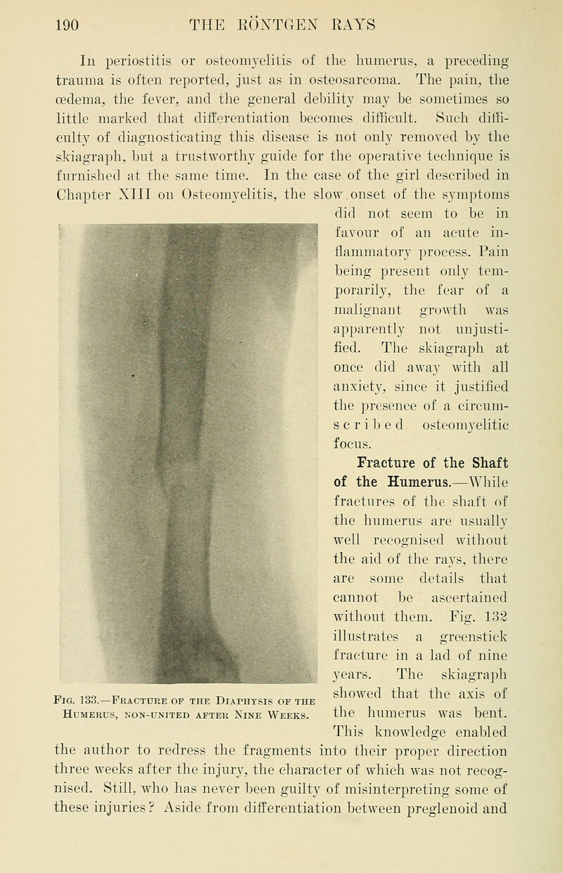 In periostitis or osteomyelitis of the humerus, a preceding trauma is often reported, just as in osteosarcoma. The pain, the oedema, the fever, and the general debility may he sometimes so little marked that differentiation becomes difficult. Such diffi- culty of diagnosticating this disease is not only removed by the skiagraph, but a trustworthy guide for the operative technique is furnished at the same time. In the case of the girl described in Chapter XIII on Osteomyelitis, the slow onset of the symptoms did not seem to be in favour of an acute in- flammatory process. Pain being present only tem- porarily, the fear of a malignant growth was apparently not unjusti- fied. The skiagraph at once did away with all anxiety, since it justified the presence of a eircum- scribed osteomyelitic focus. Fracture of the Shaft of the Humerus.—While fractures of the shaft of the humerus are usually well recognised without the aid of the rays, there are some details that cannot be ascertained without them. Fig. 132 illustrates a greenstick fracture in a lad of nine years. The skiagraph showed that the axis of the humerus was bent. This knowledge enabled the author to redress the fragments into their proper direction three weeks after the injury, the character of which was not recog- nised. Still, who has never been guilty of misinterpreting some of these injuries ? Aside from differentiation between preglenoid and Pig. 133.—Fracture of the Diaphtsis of the Humerus, non-united aftek Nine Weeks.