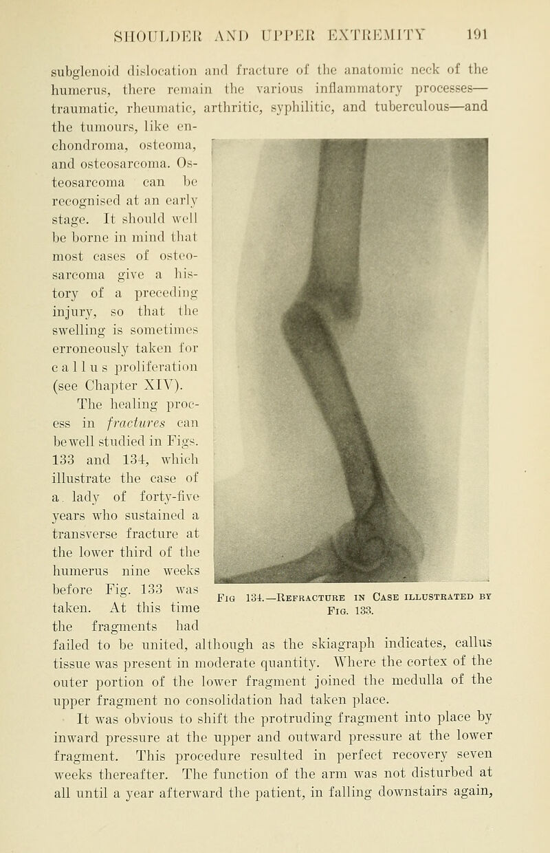 subglenoid dislocation and fracture of the anatomic neck of the humerus, there remain the various inflammatory processes— traumatic, rheumatic, arthritic, syphilitic, and tuberculous—and the tumours, like en- chondroma, osteoma, and osteosarcoma. Os- teosarcoma can be recognised at an early stage. It should well be borne in mind that most cases of osteo- sarcoma give a his- tory of a preceding injury, so that the swelling is sometimes erroneously taken for callus proliferation (see Chapter XIV). The healing proc- ess in fractures can be well studied in Figs. 133 and 134, which illustrate the case of a. lady of forty-five years who sustained a transverse fracture at the lower third of the humerus nine weeks before Fig. 133 was taken. At this time the fragments had failed to be united, although as the skiagraph indicates, callus tissue was present in moderate quantity. Where the cortex of the outer portion of the lower fragment joined the medulla of the upper fragment no consolidation had taken place. It was obvious to shift the protruding fragment into place by inward pressure at the upper and outward pressure at the lower fragment. This procedure resulted in perfect recovery seven weeks thereafter. The function of the arm was not disturbed at all until a year afterward the patient, in falling downstairs again, Fig 134.— Refracture in Case illustrated by Fig. 133.