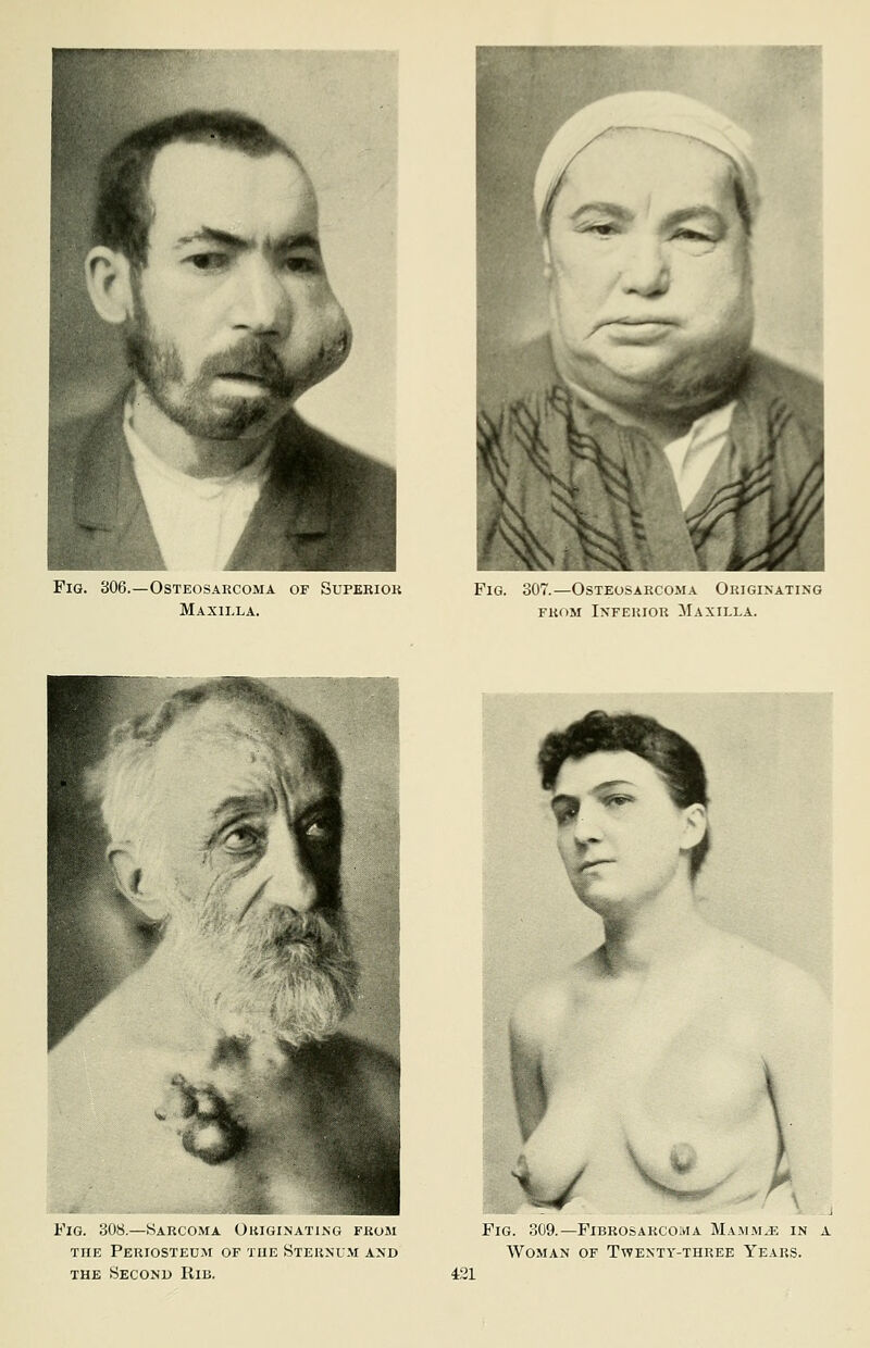 Fig. 306.—Osteosarcoma of Superior Maxilla. Fig. 307.—Osteosarcoma Originating from Inferior Maxilla. Fig. 308.—Sarcoma Originating from the Periosteum of the Sternum and Fig. 309.—Fibrosarcoma Mammae in a Woman of Twenty-three Years.