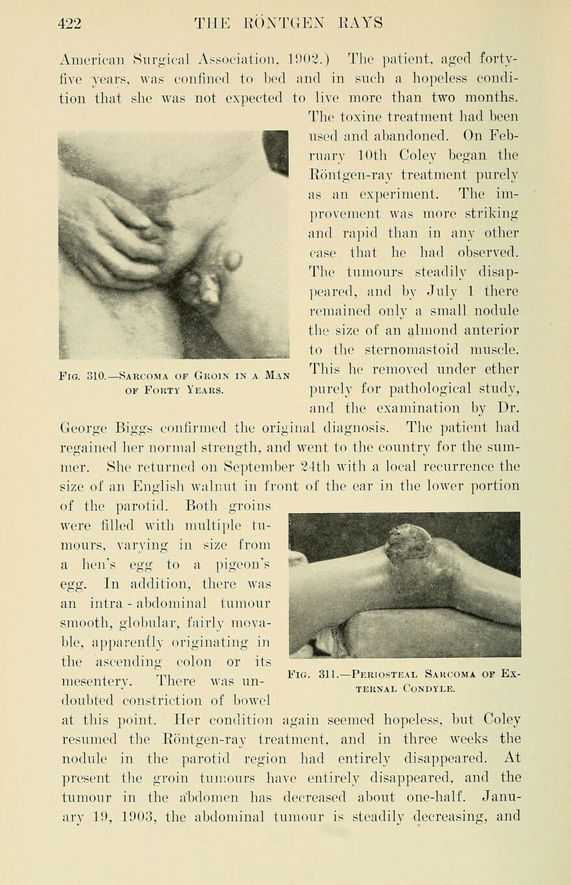 Fig. 310. -Sarcoma of Gkoin in a Man of Forty Years. American Surgical Association, 1902.) The patient, aged forty- five years, was confined to bed and in such a hopeless condi- tion that she was not expected to live more than two months. The toxine treatment had been used and abandoned. On Feb- ruary 10th Coley began the Rontgen-ray treatment purely as an experiment. The im- provement was more striking and rapid than in any other case that he had observed. The tumours steadily disap- peared, and by July 1 there remained only a small nodule the size of an almond anterior to the sternomastoid muscle. This he removed under ether purely for pathological study, and the examination by Dr. George Biggs confirmed the original diagnosis. The patient had regained her normal strength, and went to the country for the sum- mer. She returned on September 24th with a local recurrence the size of an English walnut in front of the ear in the lower portion of the parotid. Both groins were filled with multiple tu- mours, varying in size from a hen's egg to a pigeon's egg. In addition, there was an intra - abdominal tumour smooth, globular, fairly mova- ble, apparently originating in the ascending colon or its mesentery. There was un- doubted constriction of bowel at this point. Her condition again seemed hopeless, but Coley resumed the Rontgen-ray treatment, and in three weeks the nodule in the parotid region had entirely disappeared. At present the groin tumours have entirely disappeared, and the tumour in the abdomen has decreased about one-half. Janu- ary 19, 1903, the abdominal tumour is steadily decreasing, and Fig. 311.—Periosteal Sarcoma of Ex- ternal Condyle.