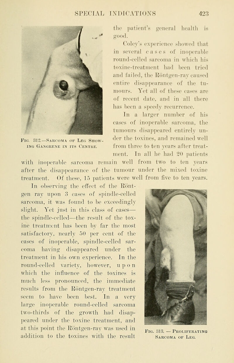 Pig. 312.—Sarcoma of Leg Show ing Gangrene in its Centre. the patient's genera] health is good. (loley's experience showed that in several c ases of inoperable round-celled sarcoma in which his toxine-treatment had been tried and Tailed, the Rontgen-ray caused entire disappearance of the tu- mours. Yet all of these cases are of recent dale, and in all there has been a speedy recurrence. In a larger number of his cases of inoperable sarcoma, the tumours disappeared entirely un- der the toxines, and remained well from three to ten years after treat- ment. In all he had 20 patients with inoperable sarcoma remain well from two to ten years after the disappearance of the tumour under the mixed toxine treatment. Of these, 15 patients were well from five to ten years. In observing the effect of the Ront- gen ray upon 3 cases of spindle-celled sarcoma, it was found to be exceedingly slight. Yet just in this class of cases— the spindle-celled—the result of the tox- ine treatment has been by far the most satisfactory, nearly 50 per cent of the cases of inoperable, spindle-celled sar- coma having disappeared under the treatment in his own experience. In the round-celled variety, however, upon which the influence of the toxines is much less pronounced, the immediate results from the Rontgen-ray treatment seem to have been best. In a very large inoperable round-celled sarcoma two-thirds of the growth had disap- peared under the toxine treatment, and at this point the Rontgen-ray was used in „ „,„ ^ 1 fa Fig. 313. — Proliferating addition to the toxines with the result Sarcoma of Leg.