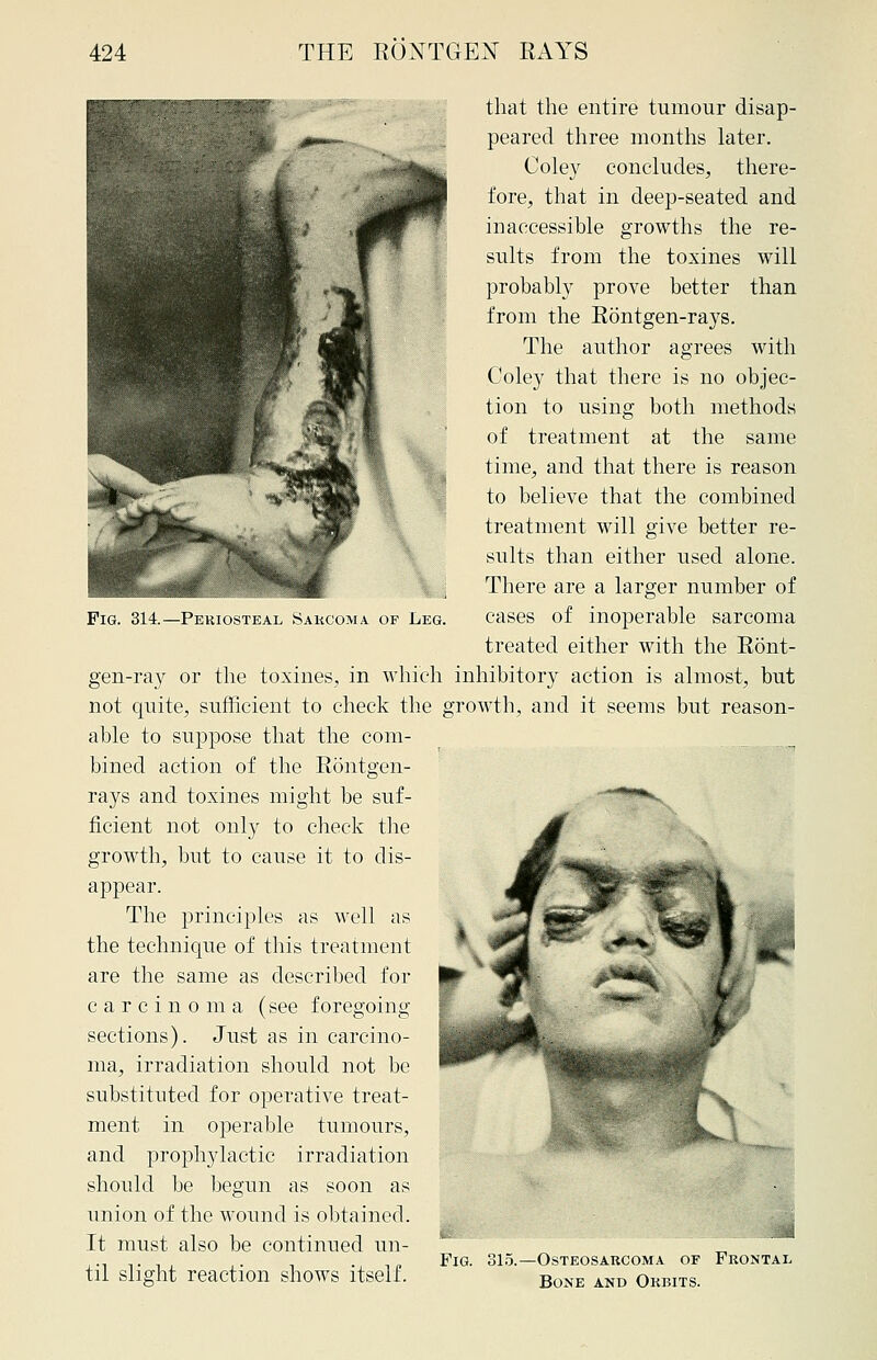 Fig. 314.—Periosteal Sarcoma of Leg. that the entire tumour disap- peared three months later. Coley concludes, there- fore, that in deep-seated and inaccessible growths the re- sults from the toxines will probably prove better than from the Rontgen-rays. The author agrees with Coley that there is no objec- tion to using both methods of treatment at the same time, and that there is reason to believe that the combined treatment will give better re- sults than either used alone. There are a larger number of cases of inoperable sarcoma treated either with the Ront- gen-ray or the toxines, in which inhibitory action is almost, but not quite, sufficient to check the growth, and it seems but reason- able to suppose that the com- bined action of the Rontgen- rays and toxines might be suf- ficient not only to check the growth, but to cause it to dis- appear. The principles as well as the technique of this treatment are the same as described for carcinoma (see foregoing sections). Just as in carcino- ma, irradiation should not be substituted for operative treat- ment in operable tumours, and prophylactic irradiation should be begun as soon as union of the wound is obtained. It must also be continued un- ....... ,. , ., n„ Fig. 315.—Osteosarcoma of Frontal til slight reaction shows itself. BoNE AND orbits