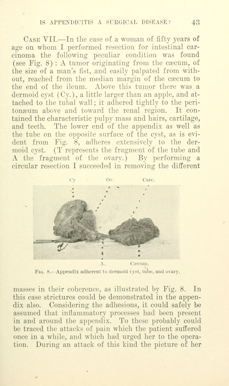 Case VII.—In the case of a •woman of fifty years of age on whom I performed resection for intestinal car- cinoma the following peculiar condition was found (see Fig. 8) : A tumor originating from the caecum, of the size of a man's fist, and easily palpated from with- out, reached from the median margin of the caecum to the end of the ileum. Above this tumor there was a dermoid cyst (Cy.), a little larger than an apple, and at- tached to the tubal wall; it adhered tightly to the peri- tonaeum above and toward the renal region. It con- tained the characteristic pulpy mass and hairs, cartilage, and teeth. The lower end of the appendix as well as the tube on the opposite surface of the cyst, as is evi- dent from Fig. 8, adheres extensively to the der- moid cyst. (T represents the fragment of the tube and A the fragment of the ovary.) By performing a circular resection I succeeded in removing the different Oy Ov. Care. ' - A. L'iecuin. Fig. 8.—Appeudis adherent to dermoid cvbt. tuue, and ovary. masses in their coherence, as illustrated by Fig. 8. In this case strictures could be demonstrated in the appen- dix also. Considering the adhesions, it could safely be assumed that inflammatory processes had been present in and around the appendix. To these probably could be traced the attacks of pain which the patient suffered once in a while, and which had urged her to the opera- tion. During an attack of this kind the picture of her