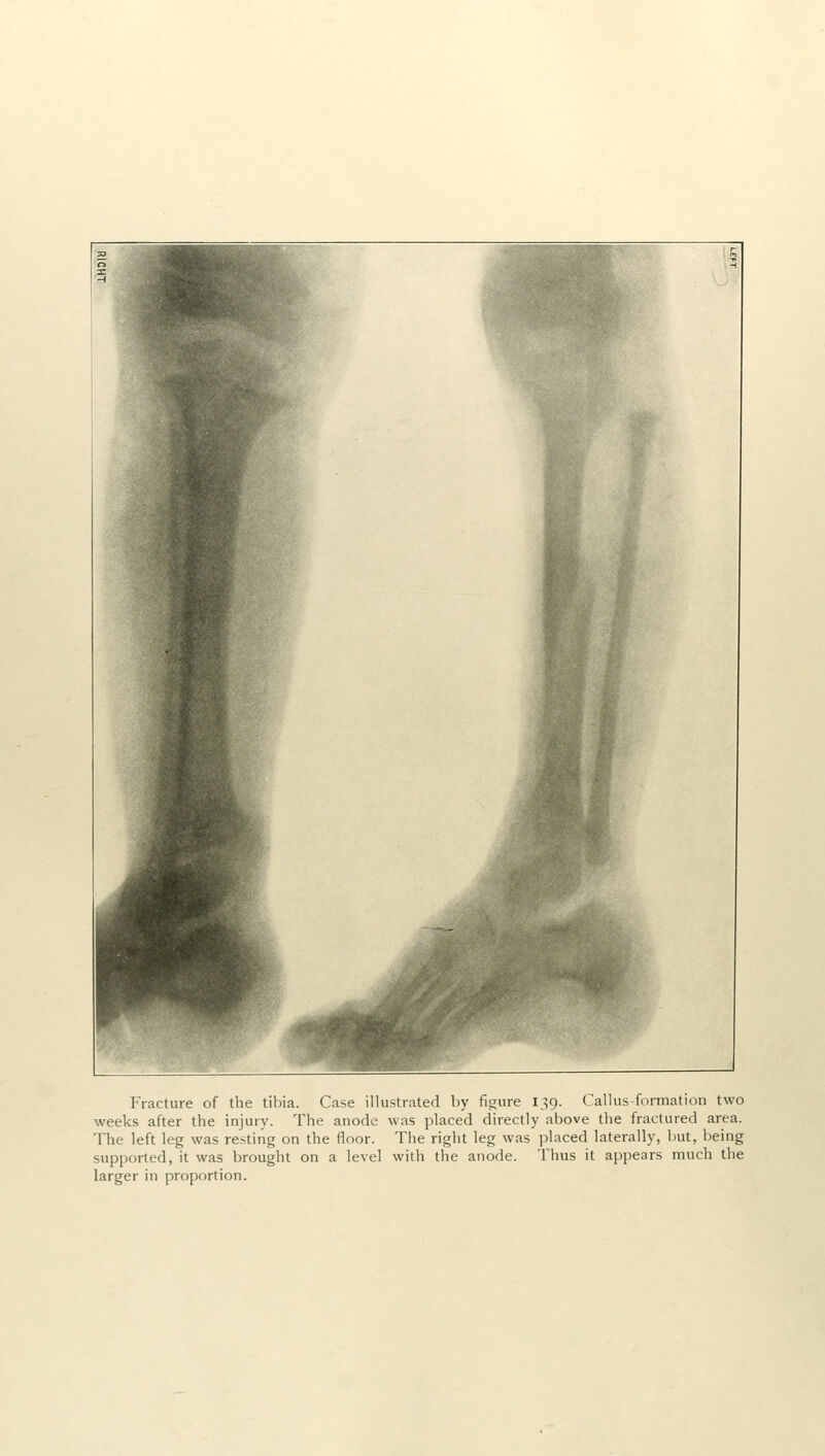 Fracture of the tibia. Case illustrated by figure 139. Callus-formation two weeks after the injury. The anode was placed directly above the fractured area. The left leg was resting on the floor. The right leg was placed laterally, but, being supported, it was brought on a level with the anode. Thus it appears much the larger in proportion.