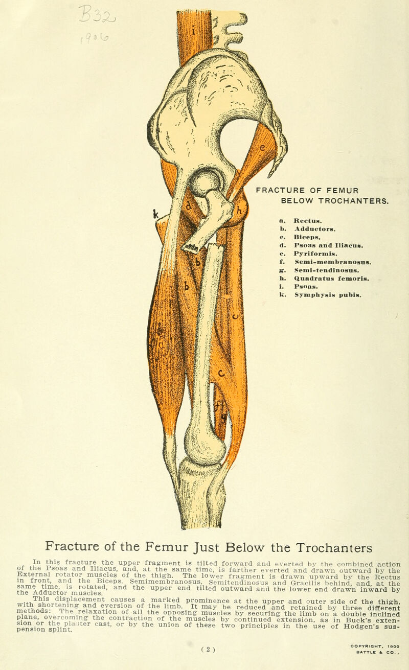 BELOW TROCHANTERS. a. Rectos. b. Adductors. c. Biceps. d. Psoas and Iliacua. e. Pyriformis. f. Semi-membranosus ST. Semi-tendinosus. h. Qnadratus femoris. 1. Psoas. k. Symphysis pubis. Fracture of the Femur Just Below the Trochanters * *in £?is fracture. tne upper fragment is tilted forward and everted bv the combined action of tne Psoas and Iliacus, and, at the same time, is farther everted and drawn outward by the External rotator muscles of the thigh. The lower fragment is drawn upward by the Rectus Lo™/0?^- ? *Bi,ceps'J Semimembranosus, Semitendinosus and Gracilis behind, and, at the fh^ iii!1; 1S rotated> and the upper end tilted outward and the lower end drawn inward by tne Aauuctor muscles. ™;+v,T^!L!iisplacemfnt causes a marked prominence at the upper and outer side of the thigh, WJ£„f£°TteJ£ns a,nd e+Yersl°n of the limb. It may be reduced and retained by three different SIt,p. n™rrn££eia?i? ? ^ the °PP°sinS muscles by securing the limb on a double inclined Pf™ A^tI > 7° contraction of the muscles by continued extension, as in Buck's exten- pension splint ' °r Uni°n °f theSe tW° PrinciPles in the use of Hodgen's sus- (2) COPYRIGHT, 190