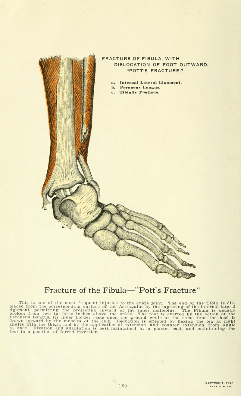 DISLOCATION OF FOOT OUTWARD. POTT'S FRACTURE. a. Internal Lateral Ligament. b. Peroneus Longus. c. Tibialis Posticus. Fracture of the Fibula—Pott's Fracture This is one of the most frequent injuries to the ankle joint. The end of the Tibia is dis- placed from the corresponding surface of the Astragalus by the rupturing of the internal lateral ligament, permitting the projecting inward of the inner malleolus. The Fibula is usually broken from two to three inches above the ankle. The foot is everted by the action of the Peroneus Longus, its inner border rests upon the ground while at the same time the heel ia drawn upward by the muscles of the calf. Reduction is effected by flexing the leg at right angles with the thigh, and by the application of extension and counter extension from ankle to knee. Fixation and adaptation is best maintained by a plaster cast, and maintaining the foot in a position of forced inversion. (6) COPYRIGHT. 1©0 1