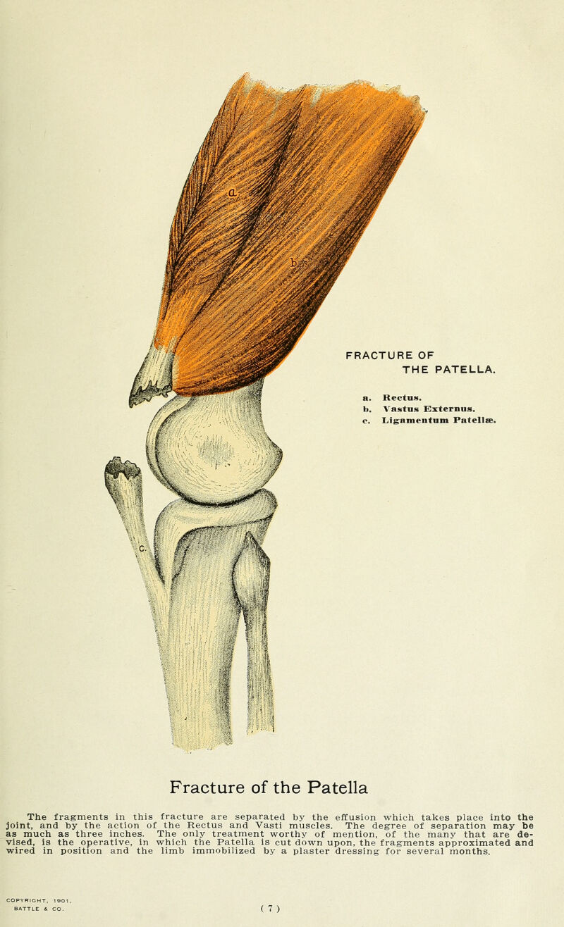 RACTl OF IE PATELLA. b. Vastus Bxternus. c. Ligamentum Patella?. Fracture of the Patella The fragments in this fracture are separated by the effusion which takes place into the joint, and by the action of the Rectus and Vasti muscles. The degree of separation may be as much as three inches. The only treatment worthy of mention, of the many that are de- vised, is the operative, in which the Patella is cut down upon, the fragments approximated and wired in position and the limb immobilized by a plaster dressing for several months.