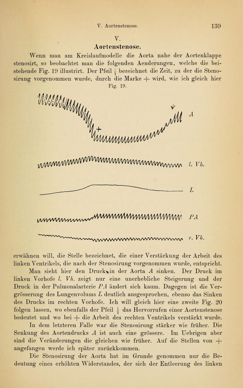 V. Aortenstenose. Wenn man am Kreislaufmodelle die Aorta nahe der Aortenklappe stenosirt, so beobachtet man die folgenden Aenderungen, welche die bei- stehende Fig. 19 illustrirt. Der Pfeil l bezeichnet die Zeit, zu der die Steno- sirung vorgenommen wurde, durch die Marke + wird, wie ich gleich hier Fig. 19. ,;UVWVV1M/V^ IVh. ..VVVVVVVVVVVVVVVVVV^^^^^ FÄ r. Vh. erwähnen will, die Stelle bezeichnet, die einer Verstärkung der Arbeit des linken Ventrikels, die nach der Stenosirung vorgenommen wurde, entspricht. Man sieht hier den Druck«» in der Aorta Ä sinken. Der Druck im linken Vorhofe l. Vh. zeigt nur eine unerhebliche Steigerung und der Druck in der Pulmonalarterie PA ändert sich kaum. Dagegen ist die Ver- grösserung des Lungenvolums L deutlich ausgesprochen, ebenso das Sinken des Drucks im rechten Vorhofe. Ich will gleich hier eine zweite Fig. 20 folgen lassen, wo ebenfalls der Pfeil A das Hervorrufen einer Aortenstenose bedeutet und wo bei -\- die Arbeit des rechten Ventrikels verstärkt wurde. In dem letzteren Falle war die Stenosirung stärker wie früher. Die Senkung des Aortendrucks A ist auch eine grössere. Im Uebrigen aber sind die Veränderungen die gleichen wie früher. Auf die Stellen von -\- angefangeu werde ich später zurückkommen. Die Stenosirung der Aorta hat im Grunde genommen nur die Be- deutung eines erhöhten Widerstandes, der sich der Entleerung des linken