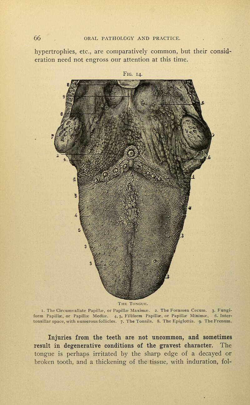 hypertrophies, etc., are comparatively common, but their consid- eration need not engross our attention at this time. Fig. 14. The Tongue. I. The Circumvallate Papillae, or Papillae Maxitnas. 2. The Foramen Cecum. 3. Fungi- form Papillae, or Papillae Medise. 4, 5. Filiform Papillae, or Papillae Minimae. 6. Inter- tonsillar space, with numerous follicles. 7. The Tonsils. 8. The Epiglottis. 9. TheFrenum. Injuries from the teeth are not uncommon, and sometimes result in degenerative conditions of the gravest character. The tongue is perhaps irritated by the sharp edge of a decayed or broken tooth, and a thickening of the tissue, with induration, fol-