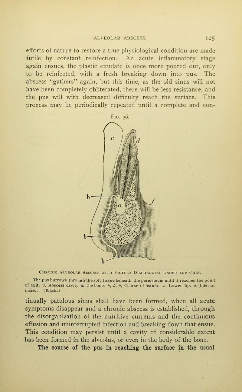 efforts of nature to restore a true physiological condition are made futile by constant reinfection. An acute inflammatory stage again ensues, the plastic exudate is once more poured out, only to be reinfected, with a fresh breaking down into pus. The abscess gathers again, but this time, as the old sinus will not have been completely obliterated, there will be less resistance, and the pus will with decreased difficulty reach the surface. This process may be periodically repeated until a complete and con- FlG. 36. Chronic Alveolar Abscess with Fistula Discharging under the Chin. The pus burrows through the soft tissue beneath the periosteum until it reaches the point of exit, a, Abscess cavity in the bone, b, b, b. Course of fistula, c, Lower lip. d, [Inferior incisor. (Black.) tinually patulous sinus shall have been formed, when all acute symptoms disappear and a chronic abscess is established, through the disorganization of the nutritive currents and the continuous effusion and uninterrupted infection and breaking down that ensue. This condition may persist until a cavity of considerable extent has been formed in the alveolus, or even in the body of the bone. The course of the pus in reaching the surface in the usual