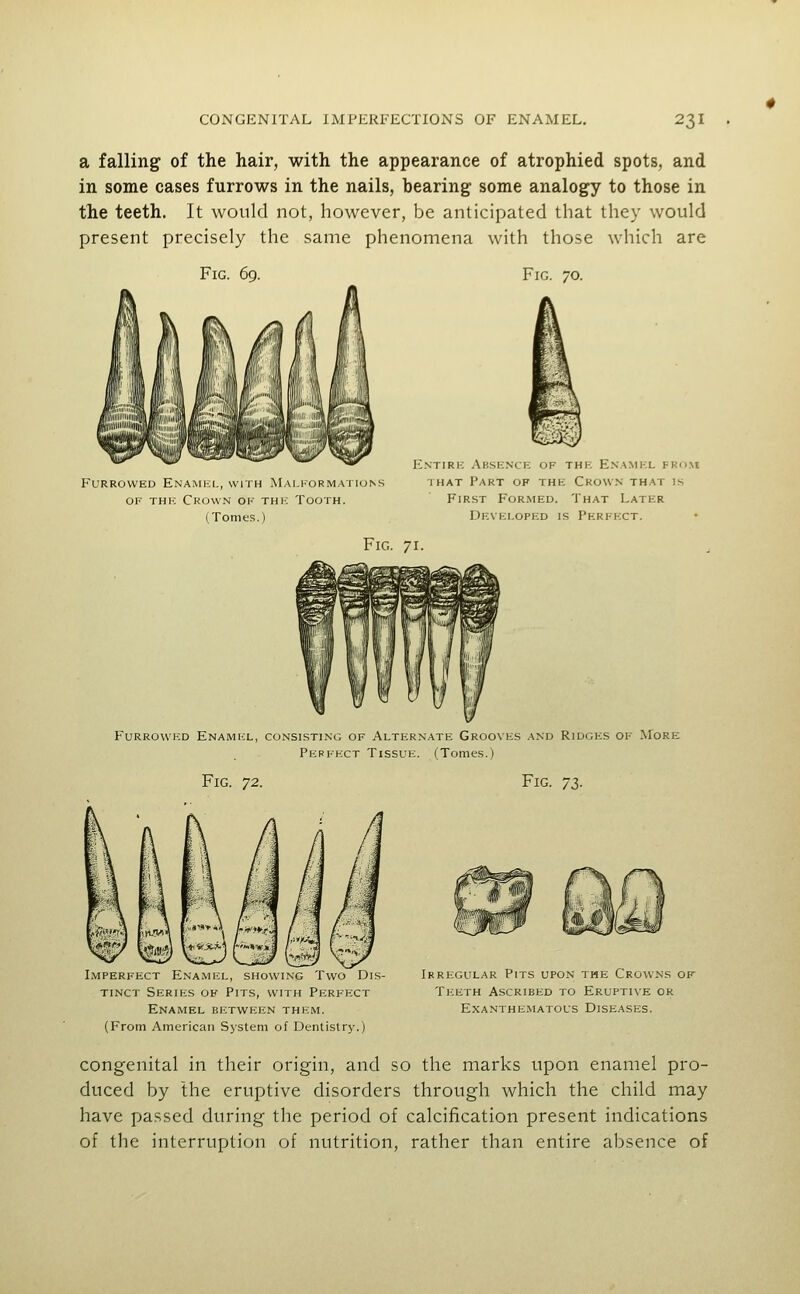 a falling of the hair, with the appearance of atrophied spots, and in some cases furrows in the nails, bearing some analogy to those in the teeth. It would not, however, be anticipated that they would present precisely the same phenomena with those which are Fig. 70. Furrowed Enamkl, with Malformations OF THK Crown of thk Tooth. (Tomes.) Fig Entiri-; .\bsk.nce of the Enamkl fru.m iHAT Part of the Crown that is First Formed. That Later Developed is Perfect. Furrowed Enamel, consisting of Alternate Grooves and Ridges of More Perfect Tissue. (Tomes.) Fig. ^2. Fig. -ji. IiMPERFFCT ESAMI r , SHOWING I WO DiS tinct Series of Pits, with Perfect Enamel between them. (From American S>'Stem of Dentistry.) Irregular Pits upon the Crowns of- Teeth Ascribed to Eruptive or Exanthe.matous Diseases. congenital in their origin, and so the marks upon enamel pro- duced by the eruptive disorders through which the child may have passed during the period of calcification present indications of the interruption of nutrition, rather than entire absence of