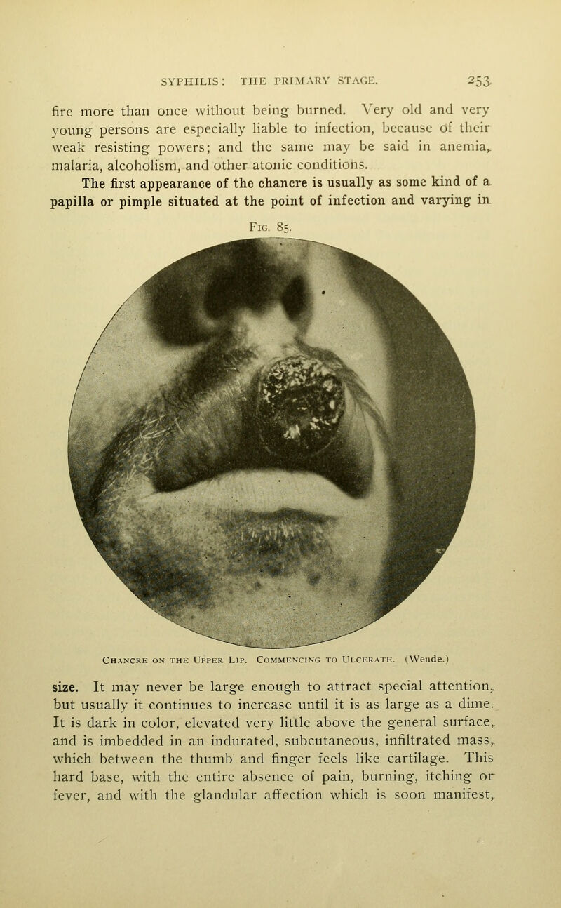 fire more than once without being burned. Very old and very young persons are especially liable to infection, because of their weak resisting powers; and the same may be said in anemia,, malaria, alcoholism, and other atonic conditions. The first appearance of the chancre is usually as some kind of a. papilla or pimple situated at the point of infection and varying in. Chancre on the Upper Lip. Commencing to Ulcerate. (Weiide.) size. It may never be large enough to attract special attention,, but usually it continues to increase until it is as large as a dime. It is dark in color, elevated very little above the general surface,, and is imbedded in an indurated, subcutaneous, infiltrated mass,, which between the thumb and finger feels like cartilage. This hard base, with the entire absence of pain, burning, itching or fever, and with the glandular afifection which is soon manifest,.