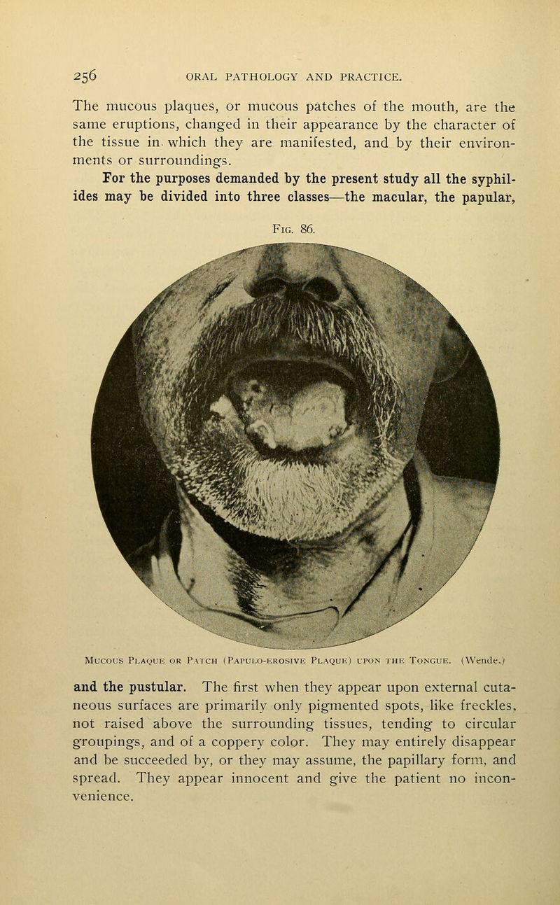 The mucous plaques, or mucous patches of the mouth, are the same eruptions, changed in their appearance by the character of the tissue in. which they are manifested, and by their environ- ments or surroundings. For the purposes demanded by the present study all the syphil- ides may be divided into three classes—the macular, the papular, Fig. 86. Mucous Plaque or Patch (Papulo-krosive Plaque) upon the Tongue. (Wende.) and the pustular. The first when they appear upon external cuta- neous surfaces are primarily only pigmented spots, like freckles, not raised above the surrounding tissues, tending to circular groupings, and of a coppery color. They may entirely disappear and be succeeded by, or they may assume, the papillary form, and spread. They appear innocent and give the patient no incon- venience.