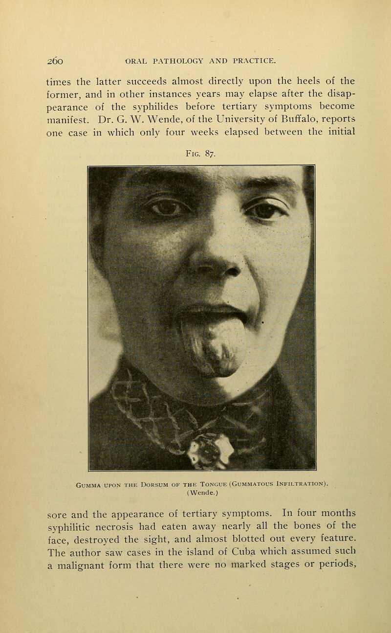 times the latter succeeds almost directly upon the heels of the former, and in other instances years may elapse after the disap- pearance of the syphiHdes before tertiary symptoms become manifest. Dr. G. W. Wende, of the University of Buffalo, reports one case in which only four weeks elapsed between the initial Fig. 87. Gumma upon the Dorsum of the Tongue (Gummatous Infiltration). (Wende.) sore and the appearance of tertiary symptoms. In four months syphilitic necrosis had eaten away nearly all the bones of the face, destroyed the sight, and almost blotted out every feature. The author saw cases in the island of Cuba which assumed such a maHgnant form that there were no marked stages or periods,