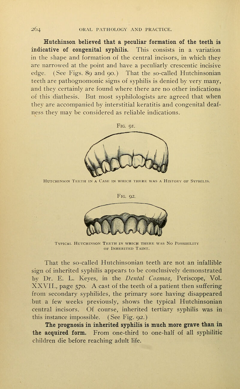 Hutchinson believed that a peculiar formation of the teeth is indicative of congenital syphilis. This consists in a variation in the shape and formation of the central incisors, in which they are narrowed at the point and have a peculiarly crescentic incisive edge. (See Figs. 89 and 90.) That the so-called Hutchinsonian teeth are pathognomonic signs of syphilis is denied by very many, and they certainly are found where there are no other indications of this diathesis. But most syphilologists are agreed that when they are accompanied by interstitial keratitis and congenital deaf- ness they may be considered as reliable indications. Fig. 91. Hutchinson Teeth in a Case in which there was a History of Syphilis. Fig. 92 Typical Hutchinson Teeth in which there was No Possibility OF Inherited Taint. That the so-called Hutchinsonian teeth are not an infallible sign of inherited syphilis appears to be conclusively demonstrated by Dr. E. L. Keyes, in the Dental Cosmos, Periscope, Vol. XXVIL, page 570. A cast of the teeth of a patient then suffering from secondary syphilides, the primary sore having disappeared but a few weeks previously, shows the typical Hutchinsonian central incisors. Of course, inherited tertiary syphilis was in this instance impossible. (See Fig. 92.) The prognosis in inherited syphilis is much more grave than in the acquired form. From one-third to one-half of all syphilitic children die before reaching adult life.