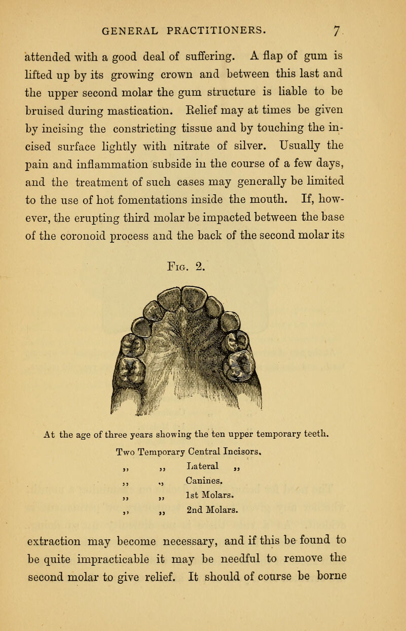 attended with a good deal of suffering. A flap of gum is lifted up by its growing crown and between this last and the upper second molar the gum structure is liable to be bruised during mastication. Belief may at times be given by incising the constricting tissue and by touching the in- cised surface lightly with nitrate of silver. Usually the pain and inflammation subside in the course of a few days, and the treatment of such cases may generally be limited to the use of hot fomentations inside the mouth. If, how- ever, the erupting third molar be impacted between the base of the coronoid process and the back of the second molar its Fig. 2. At the age of three years showing the ten upper temporary teeth. Two Temporary Central Incisors. ,, ,, Lateral „ ,, ,, Canines. ,, „ 1st Molars. ,, ,, 2nd Molars. extraction may become necessary, and if this be found to be quite impracticable it may be needful to remove the second molar to give relief. It should of course be borne