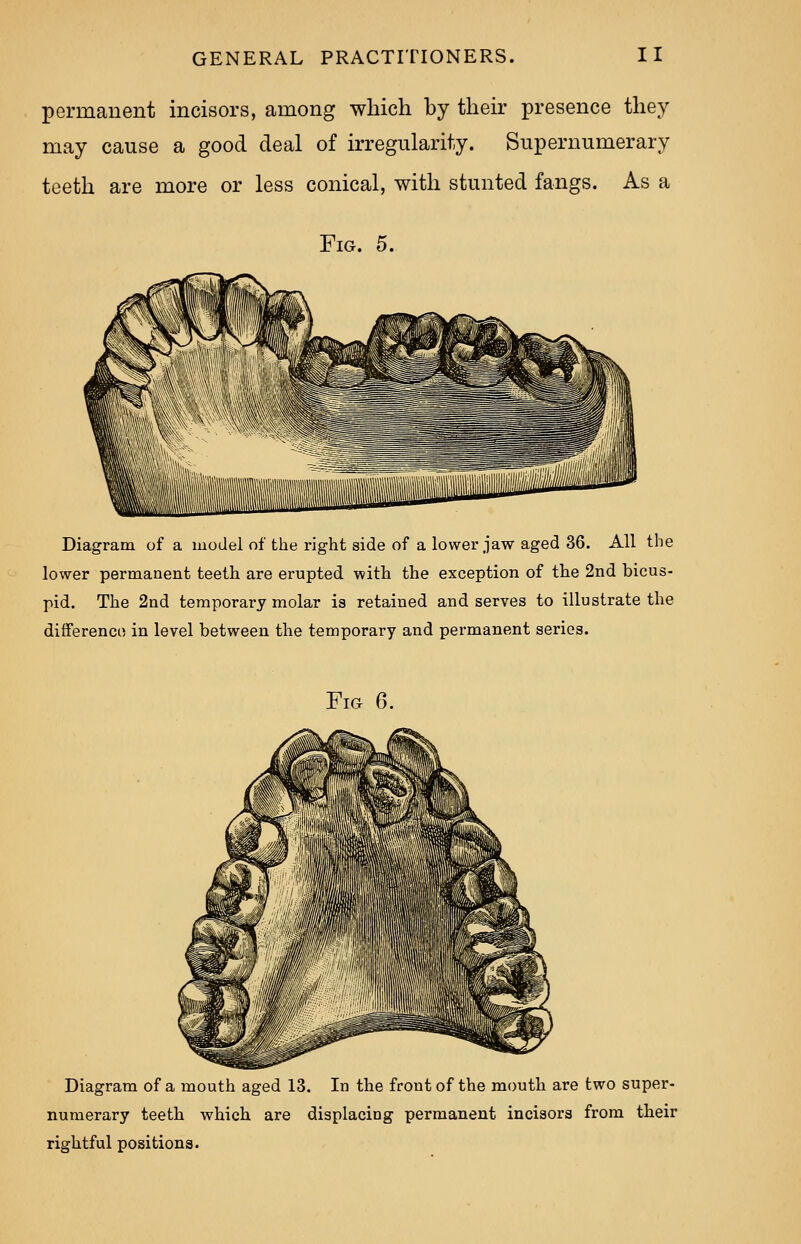 permanent incisors, among which by their presence they may cause a good deal of irregularity. Supernumerary teeth are more or less conical, with stunted fangs. As a Fig. 5. Diagram of a model of the right side of a lower jaw aged 36. All the lower permanent teeth are erupted with the exception of the 2nd bicus- pid. The 2nd temporary molar is retained and serves to illustrate the difference in level between the temporary and permanent series. Fig 6. Diagram of a mouth aged 13. In the front of the mouth are two super- numerary teeth which are displacing permanent incisors from their rightful positions.