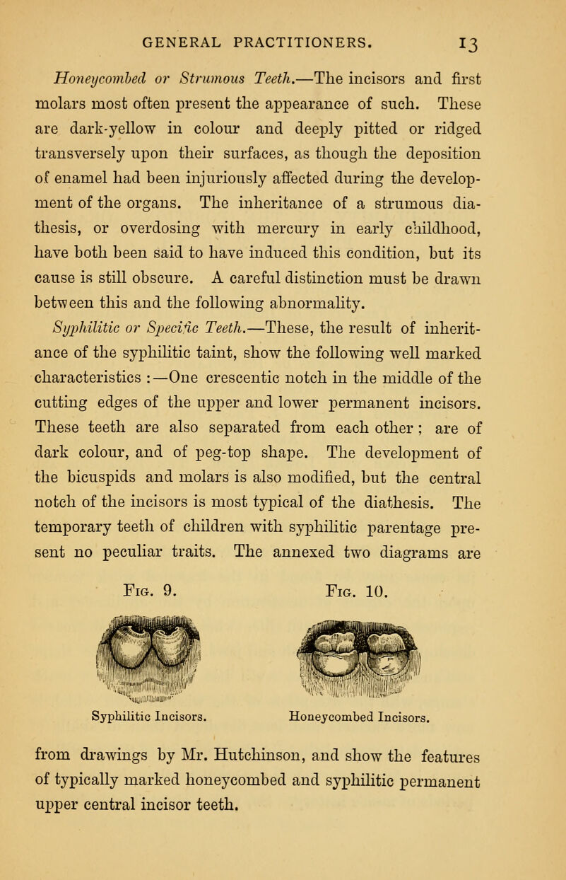 Honeycombed or Strumous Teeth.—The incisors and first molars most often present the appearance of such. These are dark-yellow in colour and deeply pitted or ridged transversely upon their surfaces, as though the deposition of enamel had been injuriously affected during the develop- ment of the organs. The inheritance of a strumous dia- thesis, or overdosing with mercury in early childhood, have both been said to have induced this condition, but its cause is still obscure. A careful distinction must be drawn between this and the following abnormality. Syiihilitic or Specifie Teeth.—These, the result of inherit- ance of the syphilitic taint, show the following well marked characteristics : —One crescentic notch in the middle of the cutting edges of the upper and lower permanent incisors. These teeth are also separated from each other ; are of dark colour, and of peg-top shape. The development of the bicuspids and molars is also modified, but the central notch of the incisors is most typical of the diathesis. The temporary teeth of children with syphilitic parentage pre- sent no peculiar traits. The annexed two diagrams are Fig. 9. Fig. 10. ''iiiu,i;.ii'lwiiiuii'»- Syphilitic Incisors. Honeycombed Incisors. from drawings by Mr. Hutchinson, and show the features of typically marked honeycombed and syphilitic permanent upper central incisor teeth.