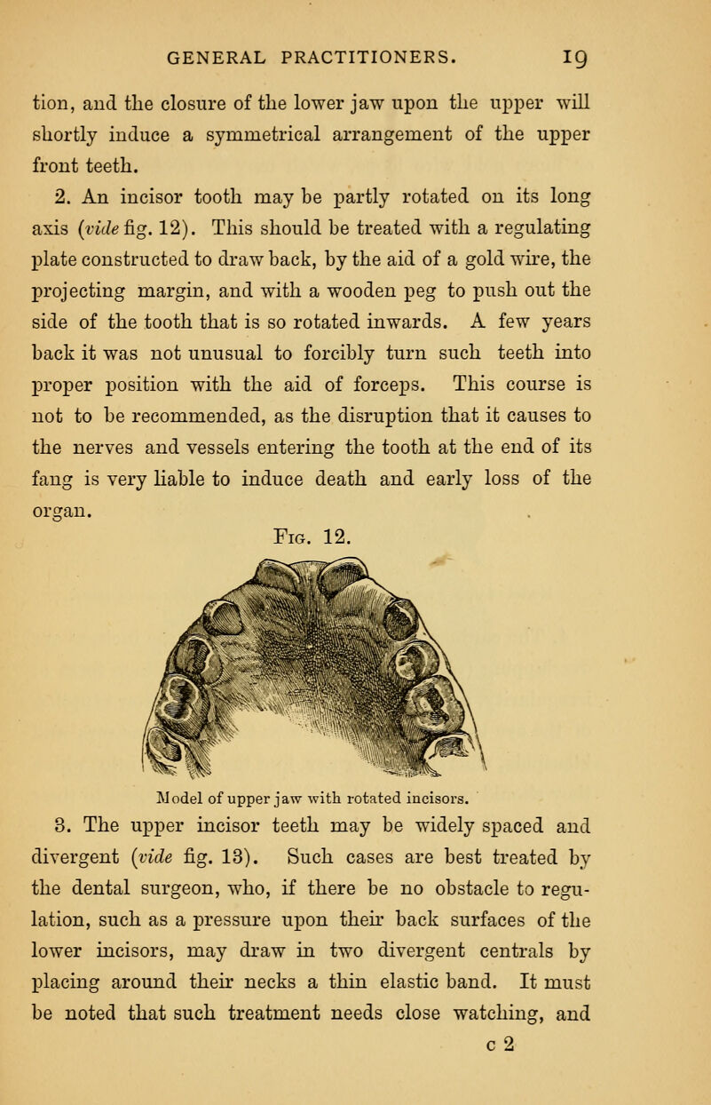 tion, and the closure of the lower jaw upon the upper will shortly induce a symmetrical arrangement of the upper front teeth. 2. An incisor tooth may be partly rotated on its long axis (videftg. 12). This should be treated with a regulating plate constructed to draw back, by the aid of a gold wire, the projecting margin, and with a wooden peg to push out the side of the tooth that is so rotated inwards. A few years back it was not unusual to forcibly turn such teeth into proper position with the aid of forceps. This course is not to be recommended, as the disruption that it causes to the nerves and vessels entering the tooth at the end of its fang is very liable to induce death and early loss of the organ. Fig. 12. Model of upper jaw with rotated incisors. 3. The upper incisor teeth may be widely spaced and divergent (vide fig. 13). Such cases are best treated by the dental surgeon, who, if there be no obstacle to regu- lation, such as a pressure upon then back surfaces of the lower incisors, may draw in two divergent centrals by j)lacing around their necks a thin elastic band. It must be noted that such treatment needs close watching, and c2