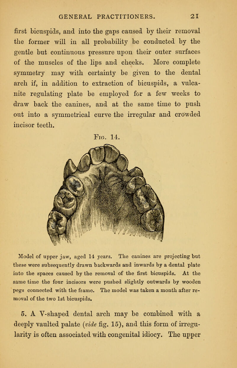 first bicuspids, and into the gaps caused by their removal the former will in all probability be conducted by the gentle but continuous pressure upon then outer surfaces of the muscles of the lips and cheeks. More complete symmetry may with certainty be given to the dental arch if, in addition to extraction of bicuspids, a vulca- nite regulating plate be employed for a few weeks to draw back the canines, and at the same time to push out into a symmetrical curve the irregular and crowded incisor teeth. Fig. 14. Model of upper jaw, aged 14 years. The canines are projecting but these were subsequently drawn backwards and inwards by a dental plate into the spaces caused by the removal of the first bicuspids. At the same time the four incisors were pushed slightly outwards by wooden pegs connected with the frame. The model was taken a month after re- moval of the two 1st bicuspids. 5. A V-shaped dental arch may be combined with a deeply vaulted palate {vide fig. 15), and this form of irregu- larity is often associated with congenital idiocy. The upper