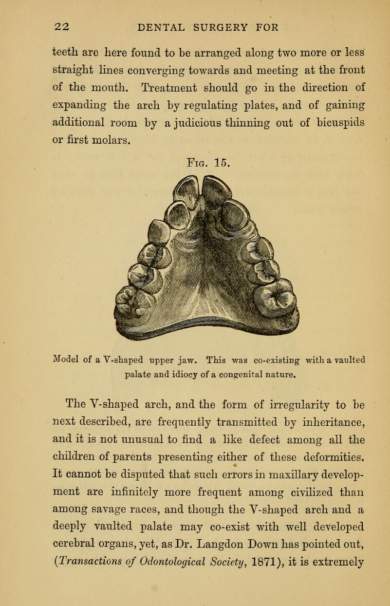 teeth are here found to be arranged along two more or less straight lines converging towards and meeting at the front of the mouth. Treatment should go in the direction of expanding the arch by regulating plates, and of gaining additional room by a judicious thinning out of bicuspids or first molars. Fig. 15. Model of a V-shaped upper jaw. This was co-existing with a vaulted palate and idiocy of a congenital nature. The V-shaped arch, and the form of irregularity to be next described, are frequently transmitted by inheritance, and it is not unusual to find a like defect among all the children of parents presenting either of these deformities. It cannot be disputed that such errors in maxillary develop- ment are infinitely more frequent among civilized than among savage races, and though the V-shaped arch and a deeply vaulted palate may co-exist with well developed cerebral organs, yet, as Dr. Langdon Down has pointed out, (Transactions of Odontological Society, 1871), it is extremely