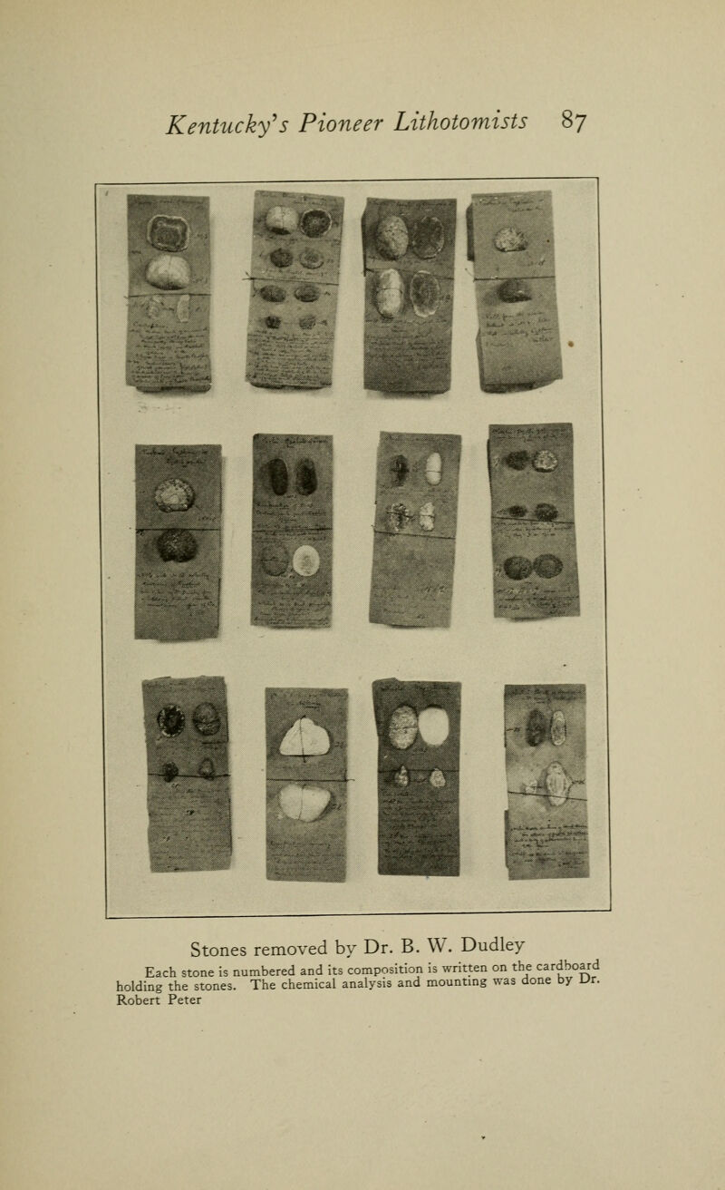 Stones removed by Dr. B. W. Dudley Each stone is numbered and its composition is written on the cardboard holding the stones. The chemical analysis and mountmg was done by Ur. Robert Peter