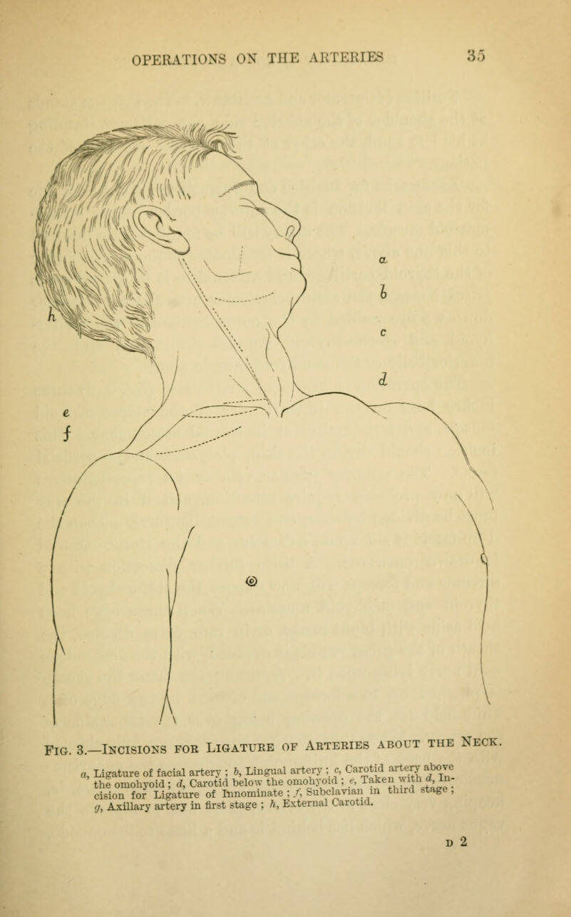 Fig. 3.—Incisions for Ligature of Arteries about the Neck. a, Ligature of facial artery ; b, Lingual artery : c ^«*^%°£m the omohyoid ; d, Carotid below the omohyoid : e, Taken ™AjMf; cision for Ligature of Innominate ; /, Subclavian in third ,tage , g, Axillary artery in first stage ; h, External Carotid. D 2