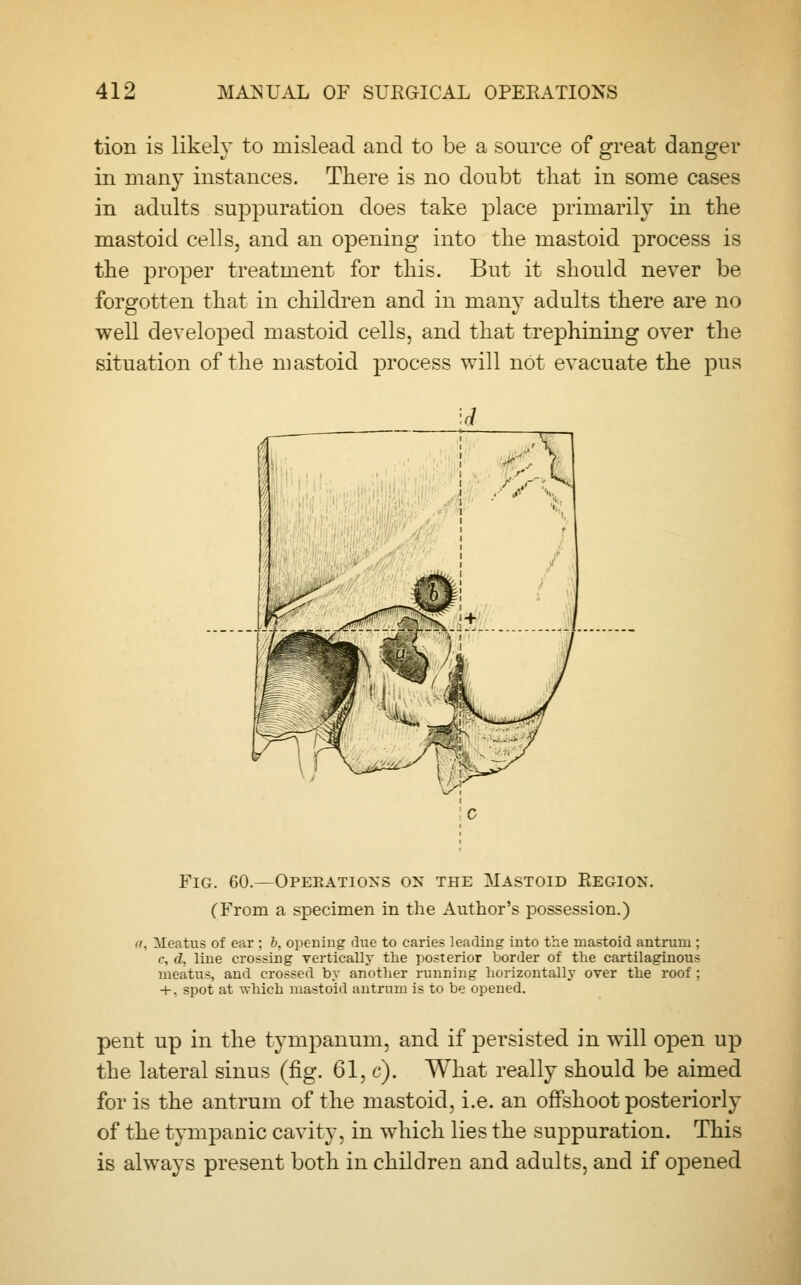 tion is likely to mislead and to be a source of great danger in many instances. There is no doubt that in some cases in adults suppuration does take place primarily in the mastoid cells, and an opening into the mastoid process is the proper treatment for this. But it should never be forgotten that in children and in many adults there are no well developed mastoid cells, and that trephining over the situation of the mastoid process will not evacuate the pus Fig. 60.—Opekations on the Mastoid Region. (From a specimen in the Author's possession.) a, Meatus of ear ; b, opening due to caries leading into the mastoid antrum ; c, d, line crossing vertically the posterior border of the cartilaginous meatus, and crossed by another running horizontally over the roof ; + , spot at which mastoid antrum is to be opened. pent up in the tympanum, and if persisted in will open up the lateral sinus (fig. 61, c). What really should be aimed for is the antrum of the mastoid, i.e. an offshoot posteriorly of the tympanic cavity, in which lies the suppuration. This is always present both in children and adults, and if opened